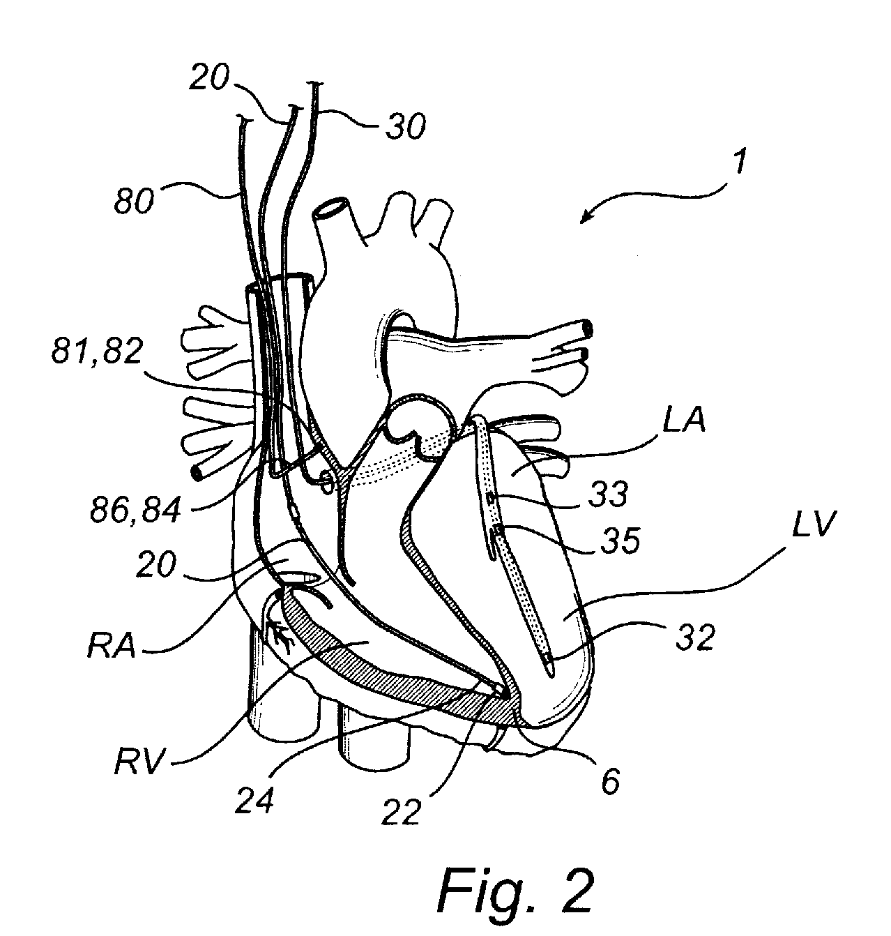Method, device, implantable stimulator and dual chamber cardiac therapy system