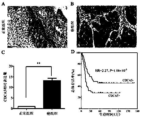 Cancer/testis antigen CDCA5 as esophageal squamous cell carcinoma prognostic marker and esophageal squamous cell carcinoma prognostic marker therapeutic target