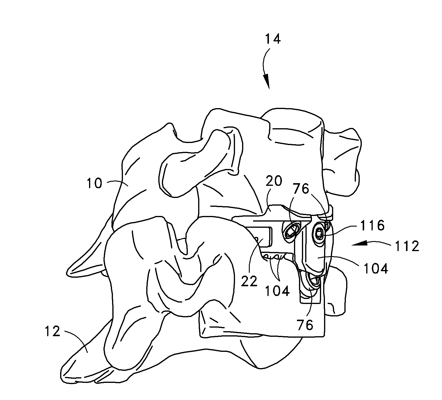 Selective implantation kit and method including tool for spacer and/or controlled subsidence device