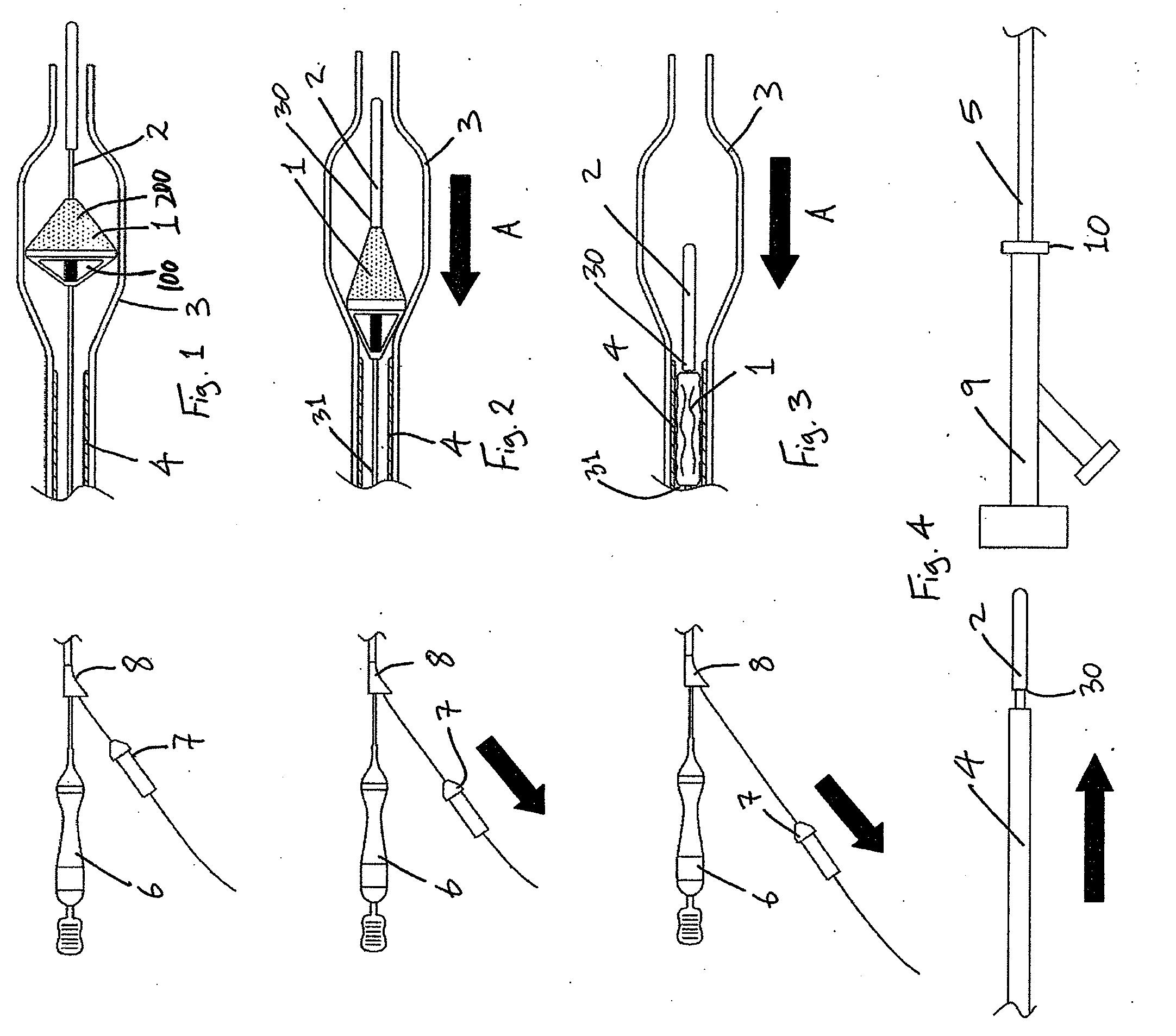 Method for filtering embolic material