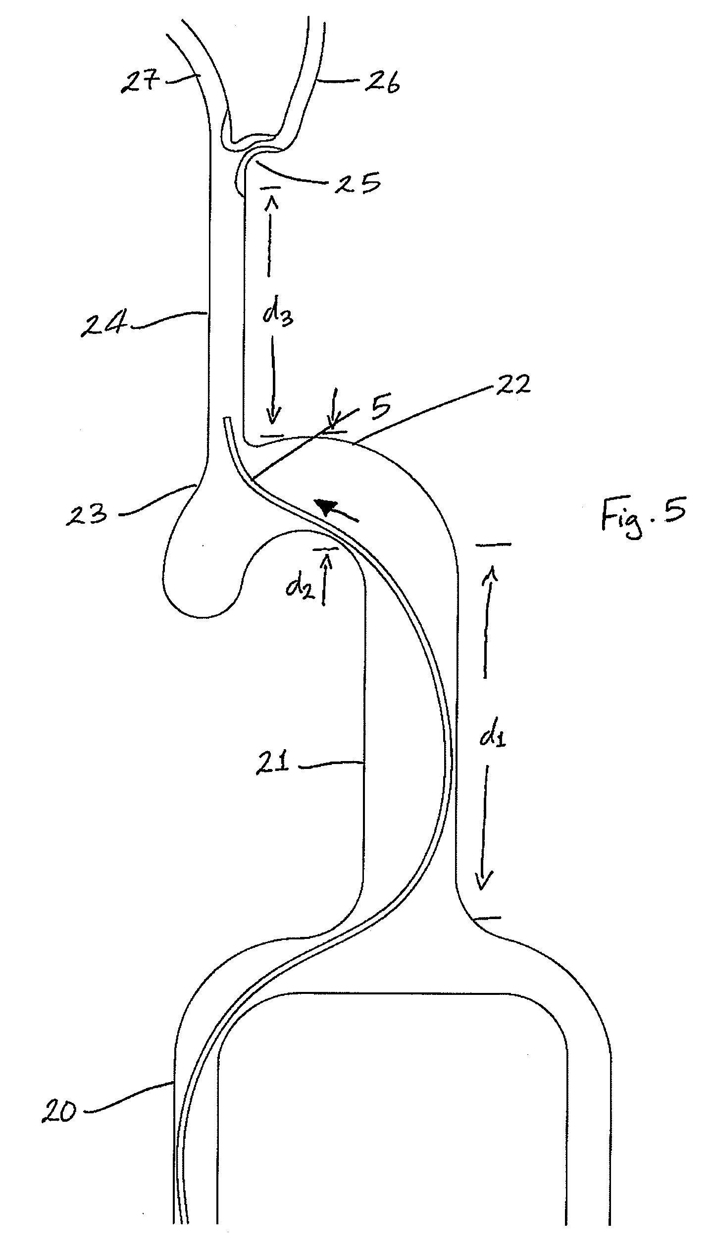 Method for filtering embolic material