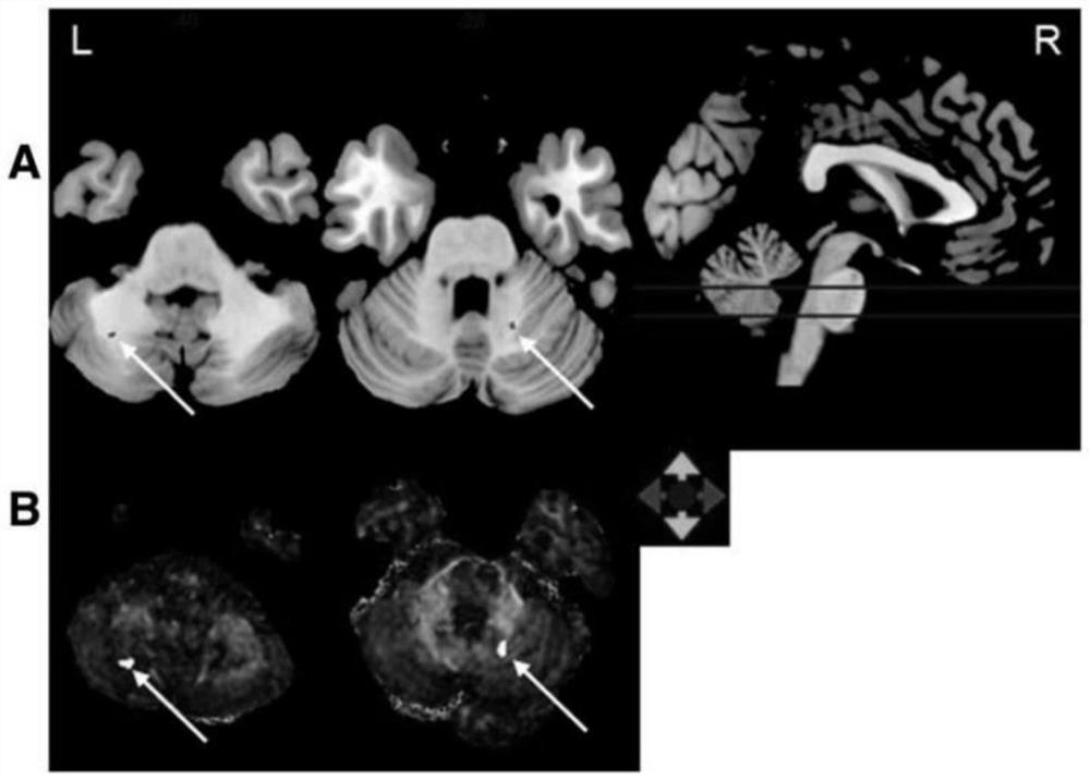 A multimodal molecular imaging approach for radiation-induced brain injury biomarkers