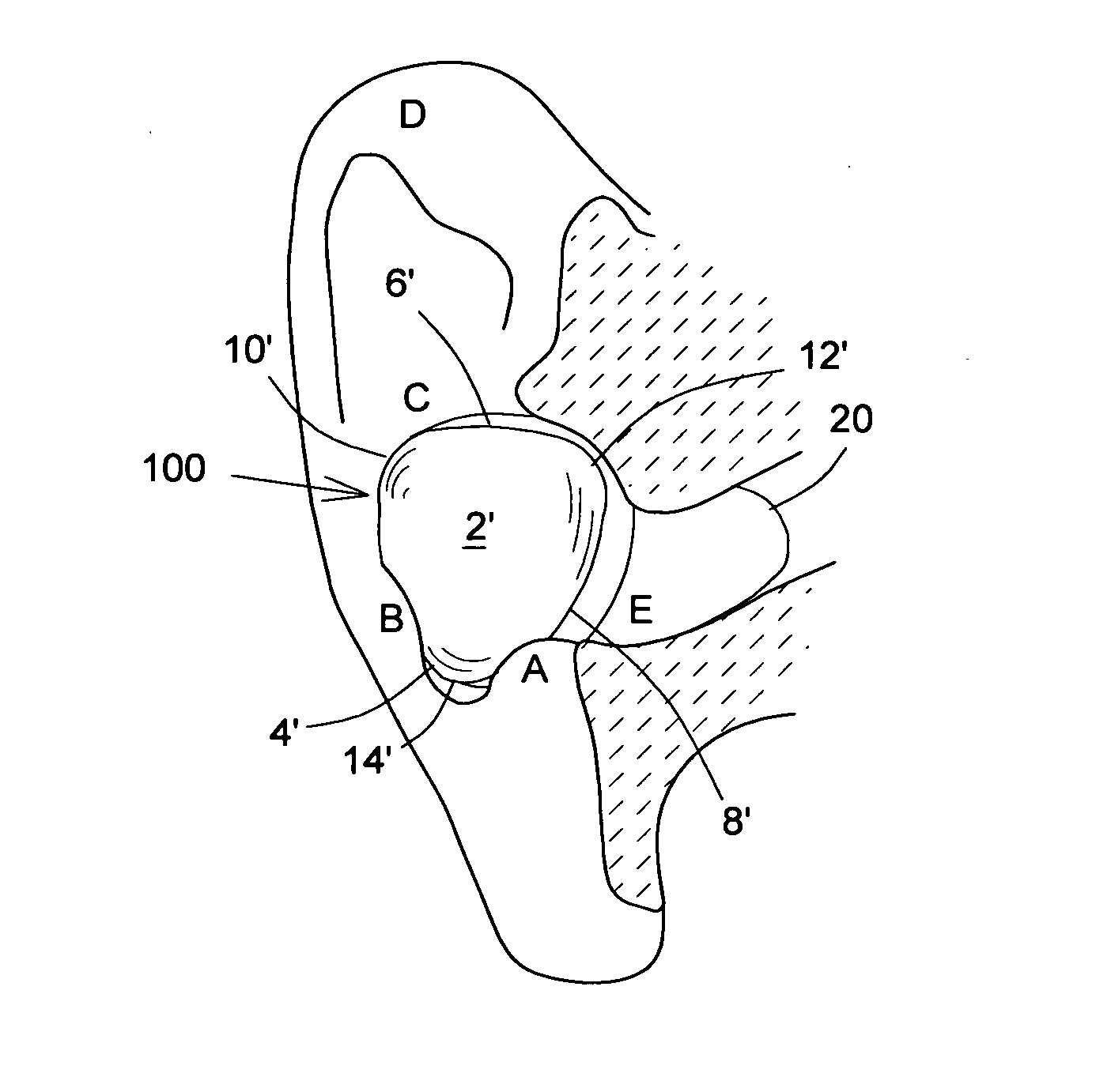 Quasi-triangular in-ear device