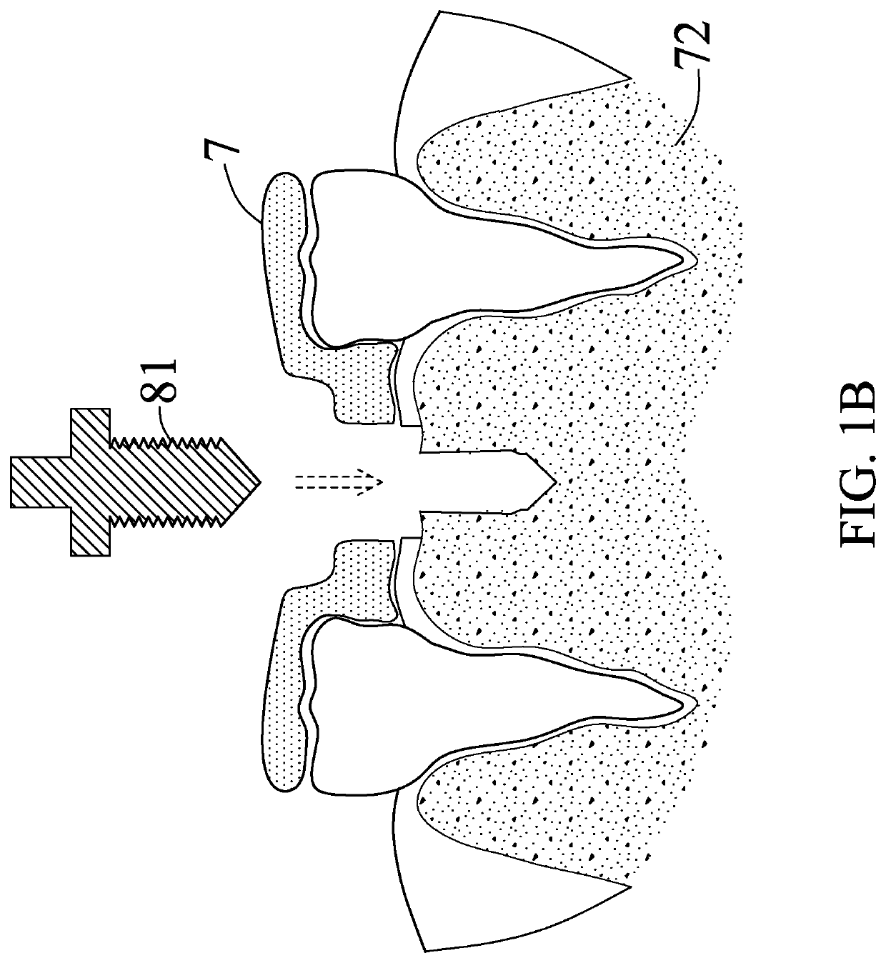 Telescopic casing