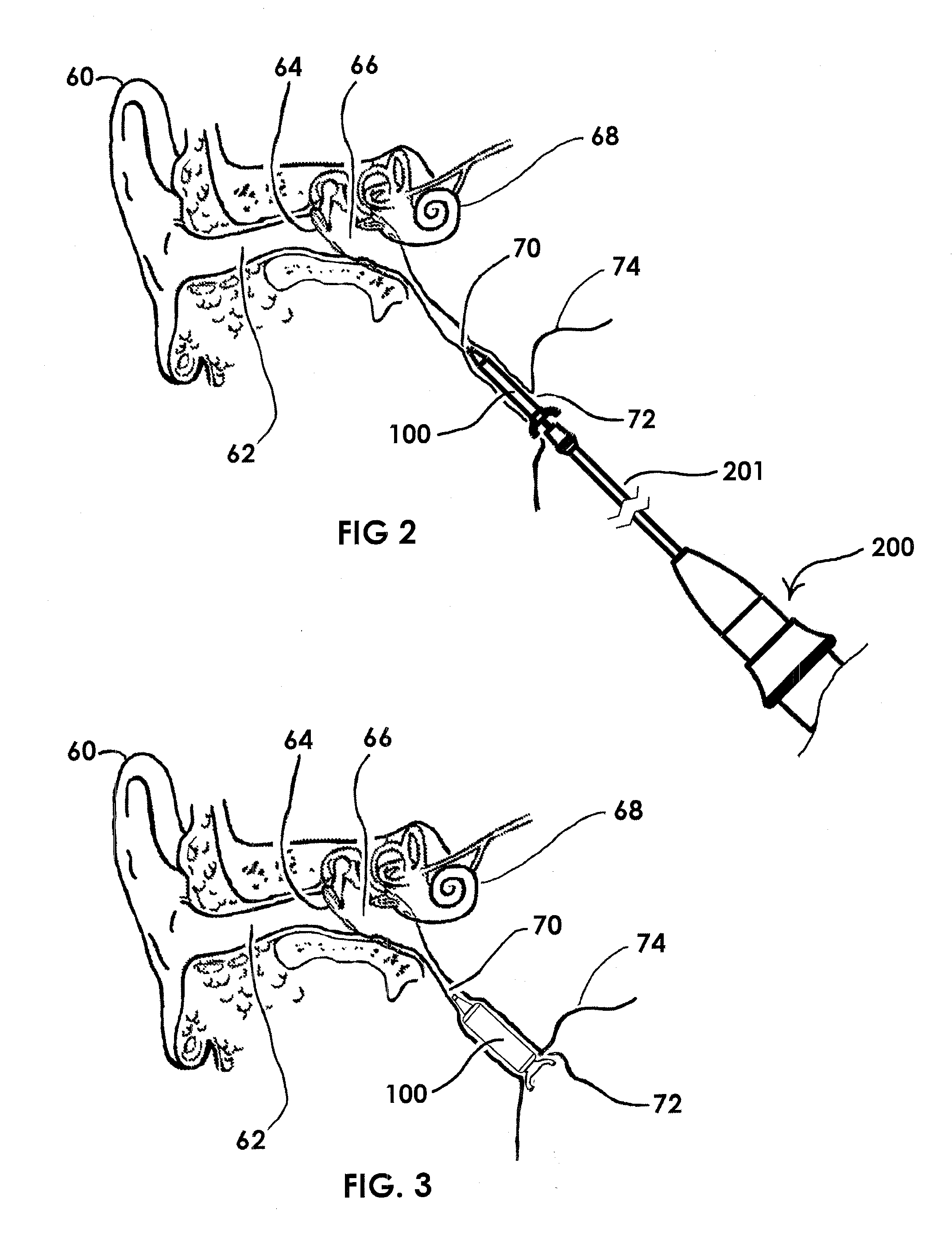 Devices and methods for Dilating a Eustachian Tube