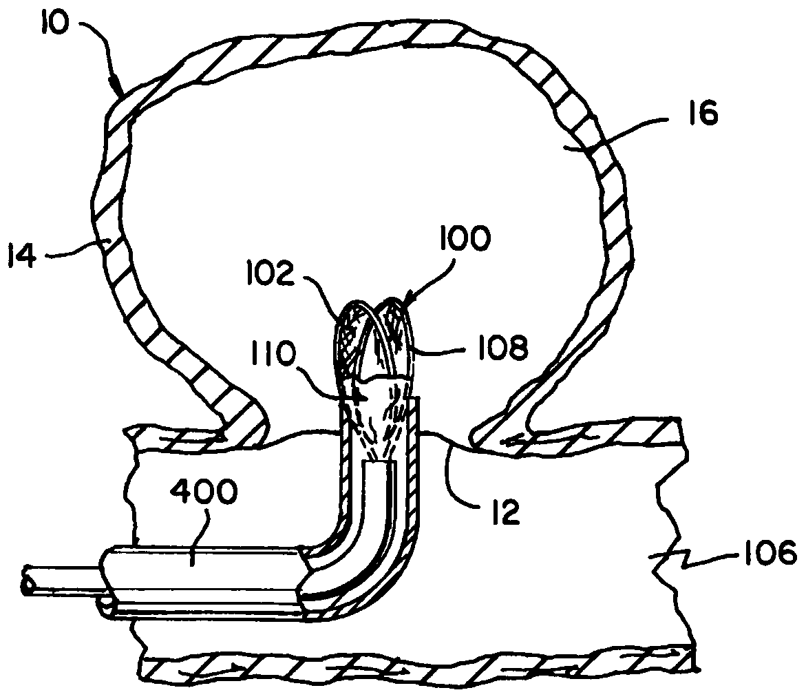 Adhesive cover occluding device for aneurysm treatment