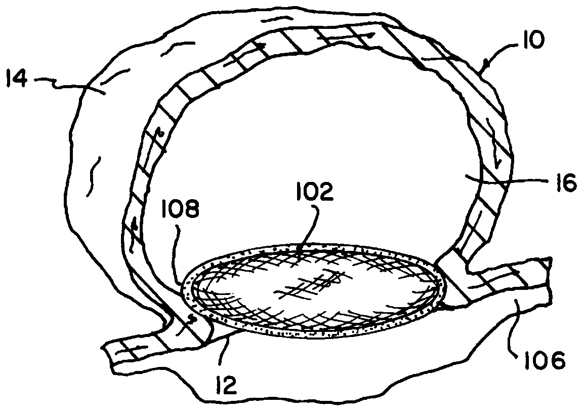 Adhesive cover occluding device for aneurysm treatment