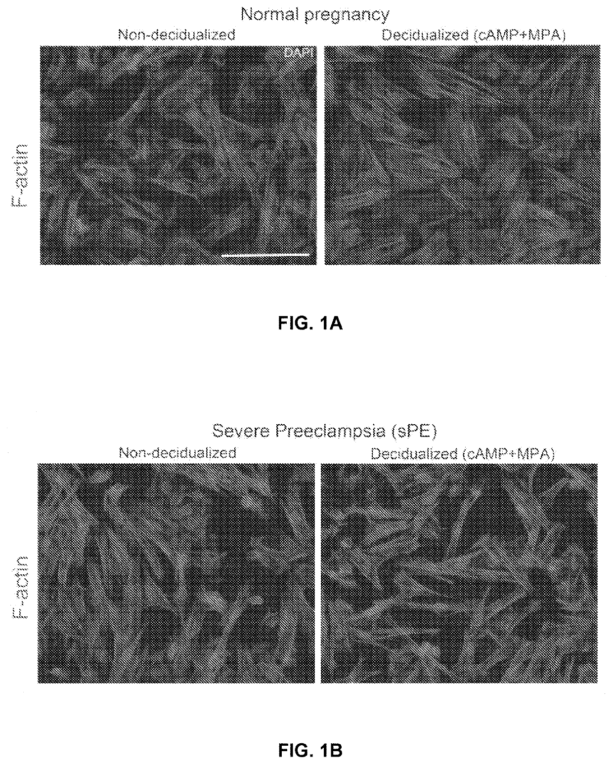 Methods and devices for detecting biomarkers associated with preeclampsia