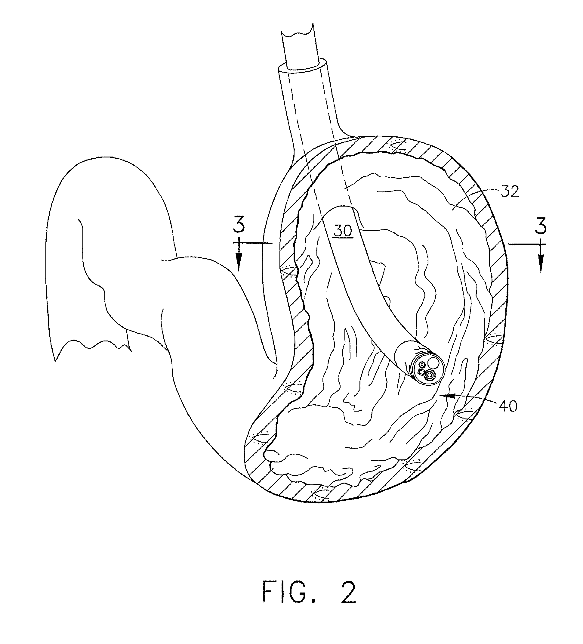 Device for insufflating the interior of a gastric cavity of a patient