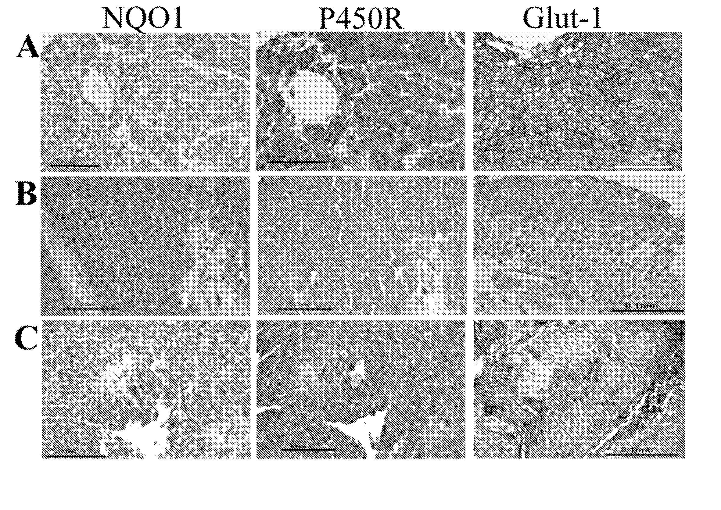 Bladder cancer treatment and methods