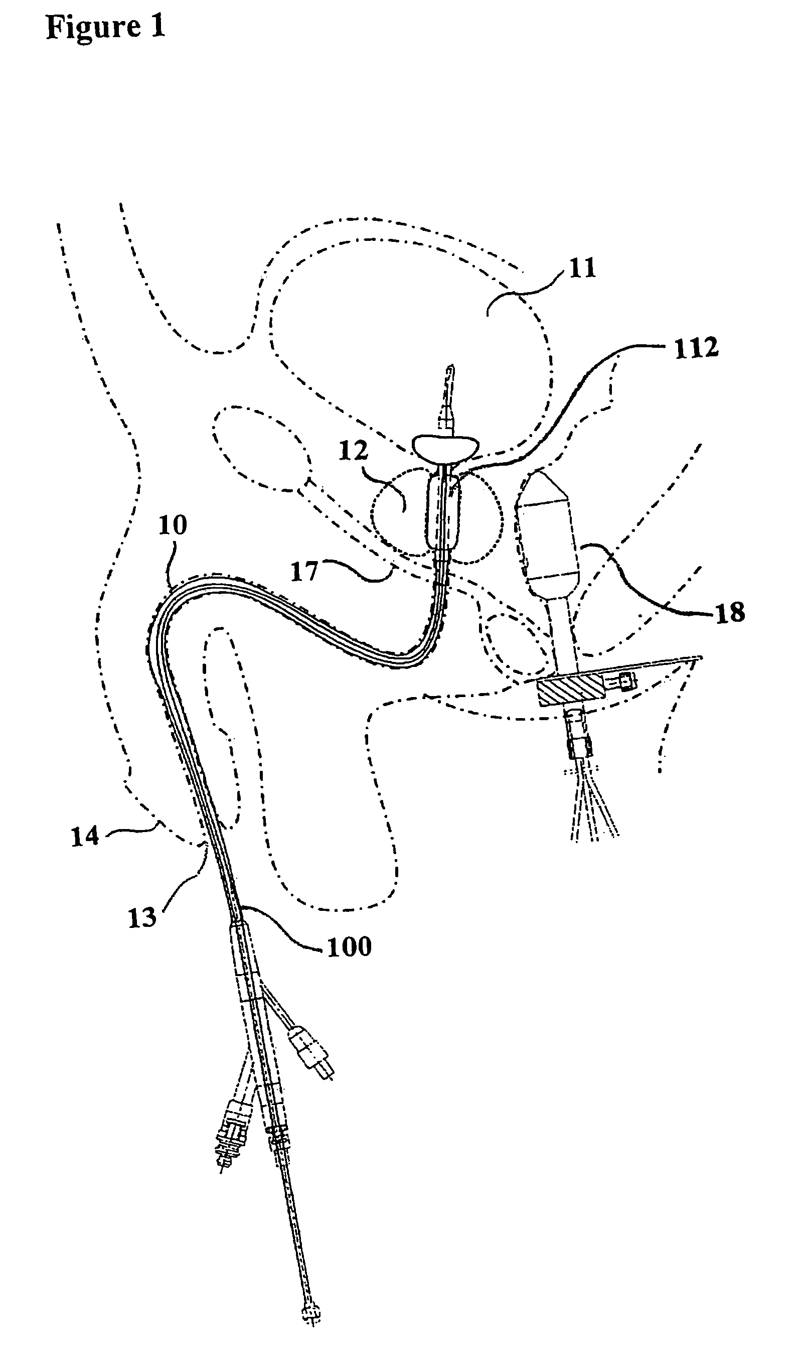 Device for treatment of tissue adjacent a bodily conduit by thermocompression