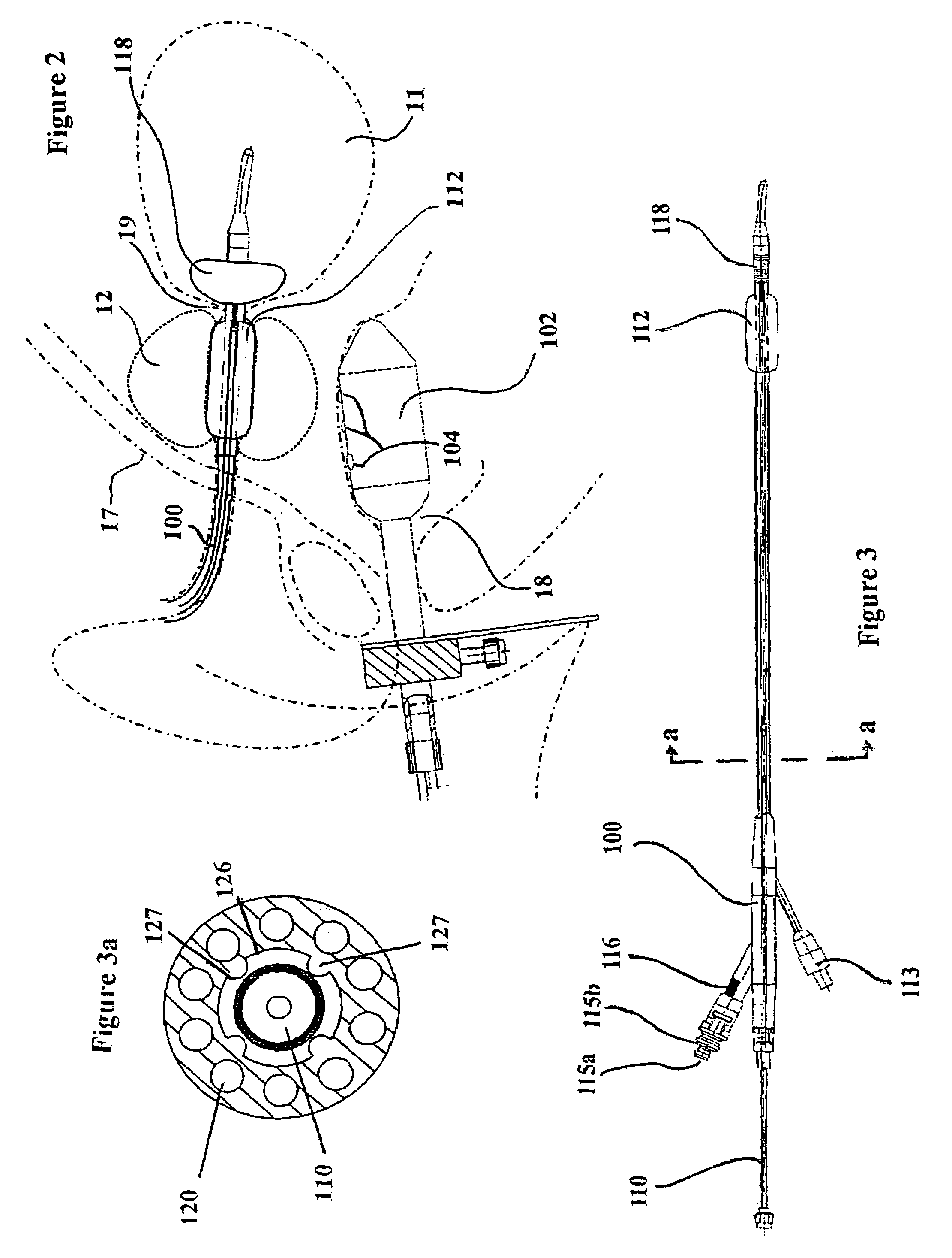 Device for treatment of tissue adjacent a bodily conduit by thermocompression