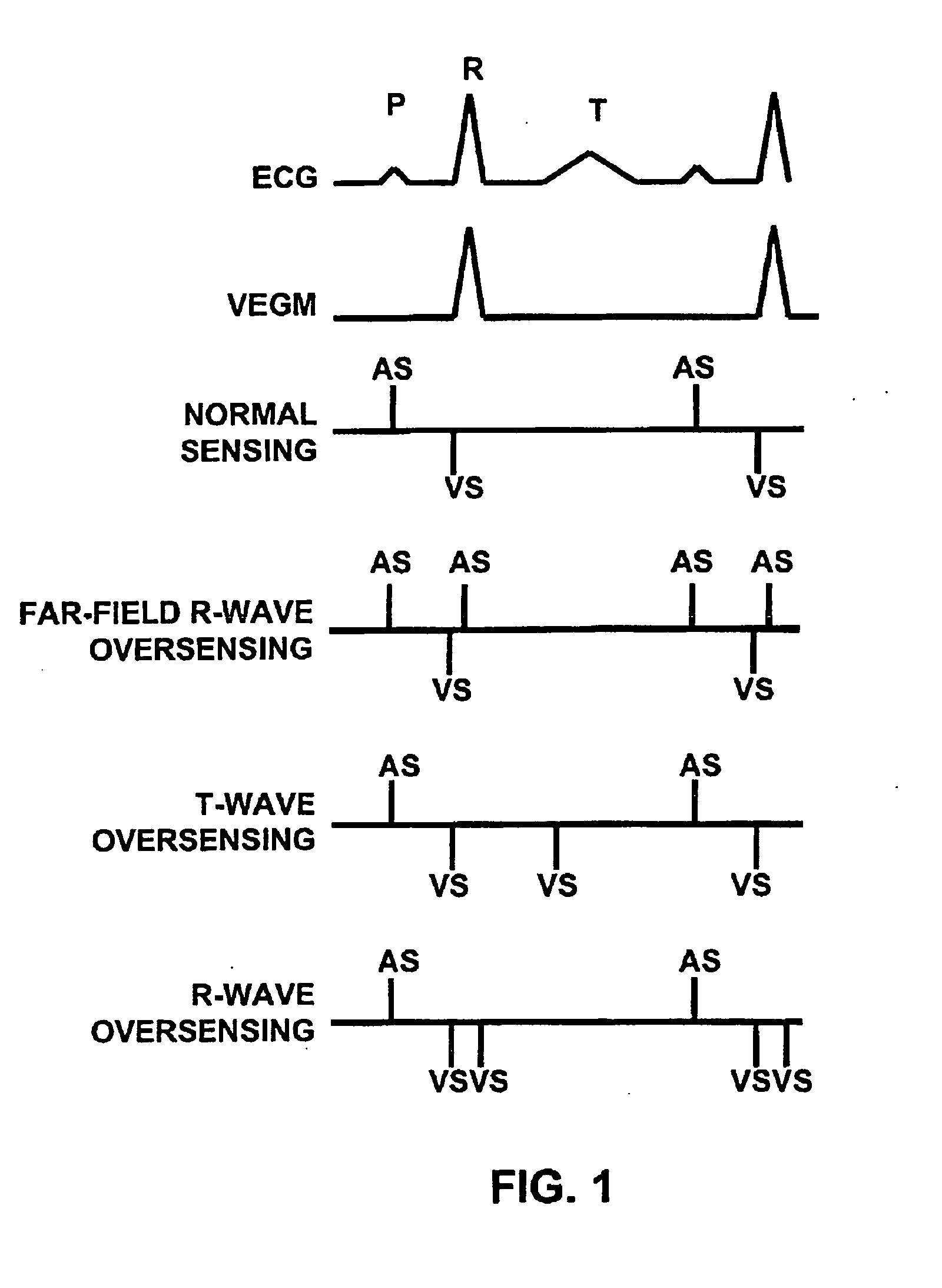 Method and apparatus for identifying oversensing using far-field intracardiac electrograms and marker channels