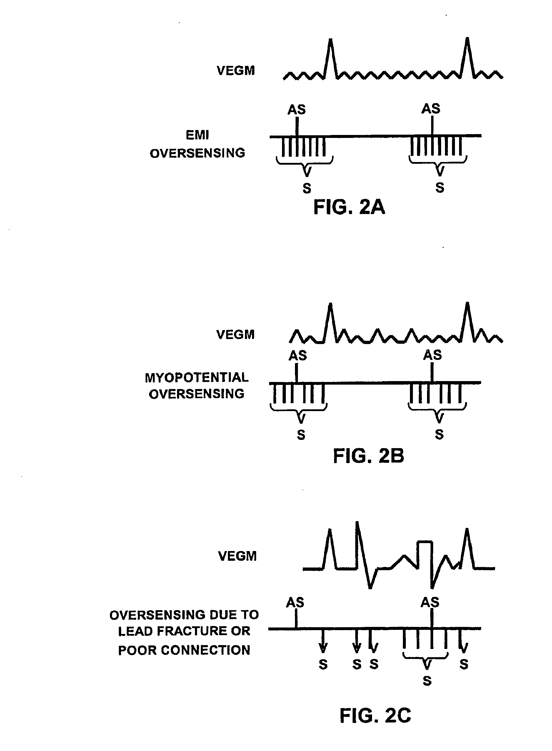 Method and apparatus for identifying oversensing using far-field intracardiac electrograms and marker channels
