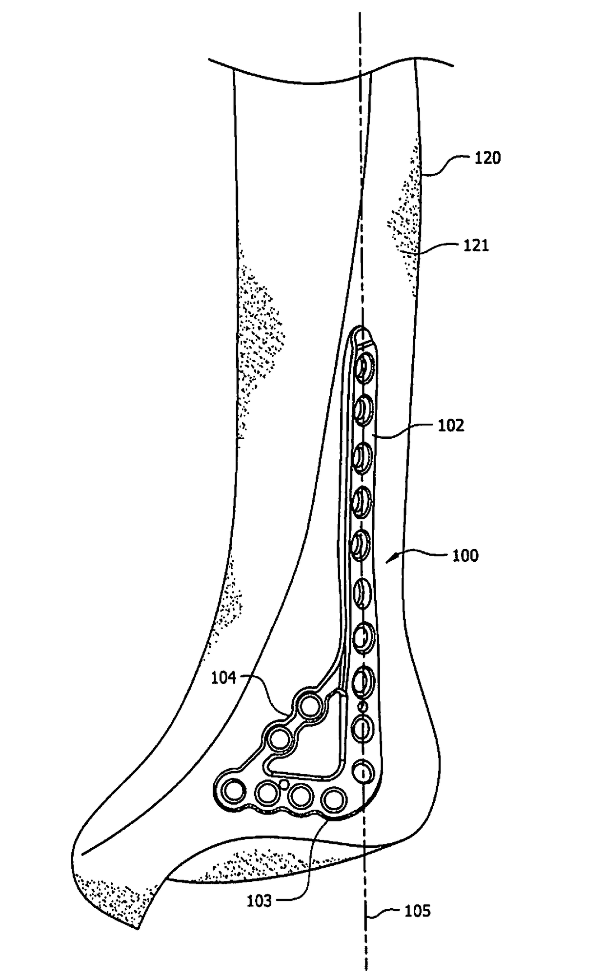 Ankle tibia plates