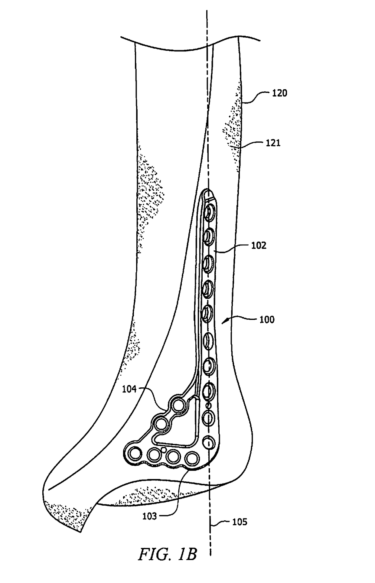 Ankle tibia plates