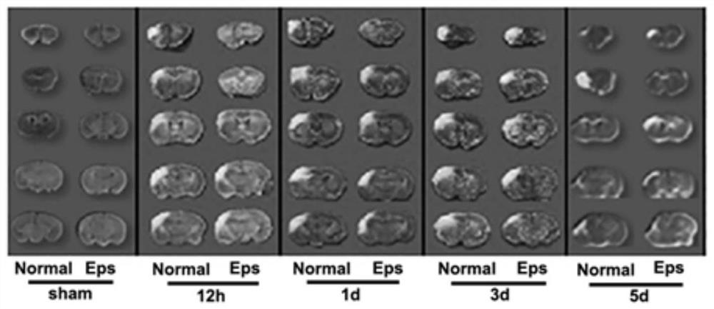 Application of epalrestat in preparation of medicine for preventing and treating cerebral arterial thrombosis