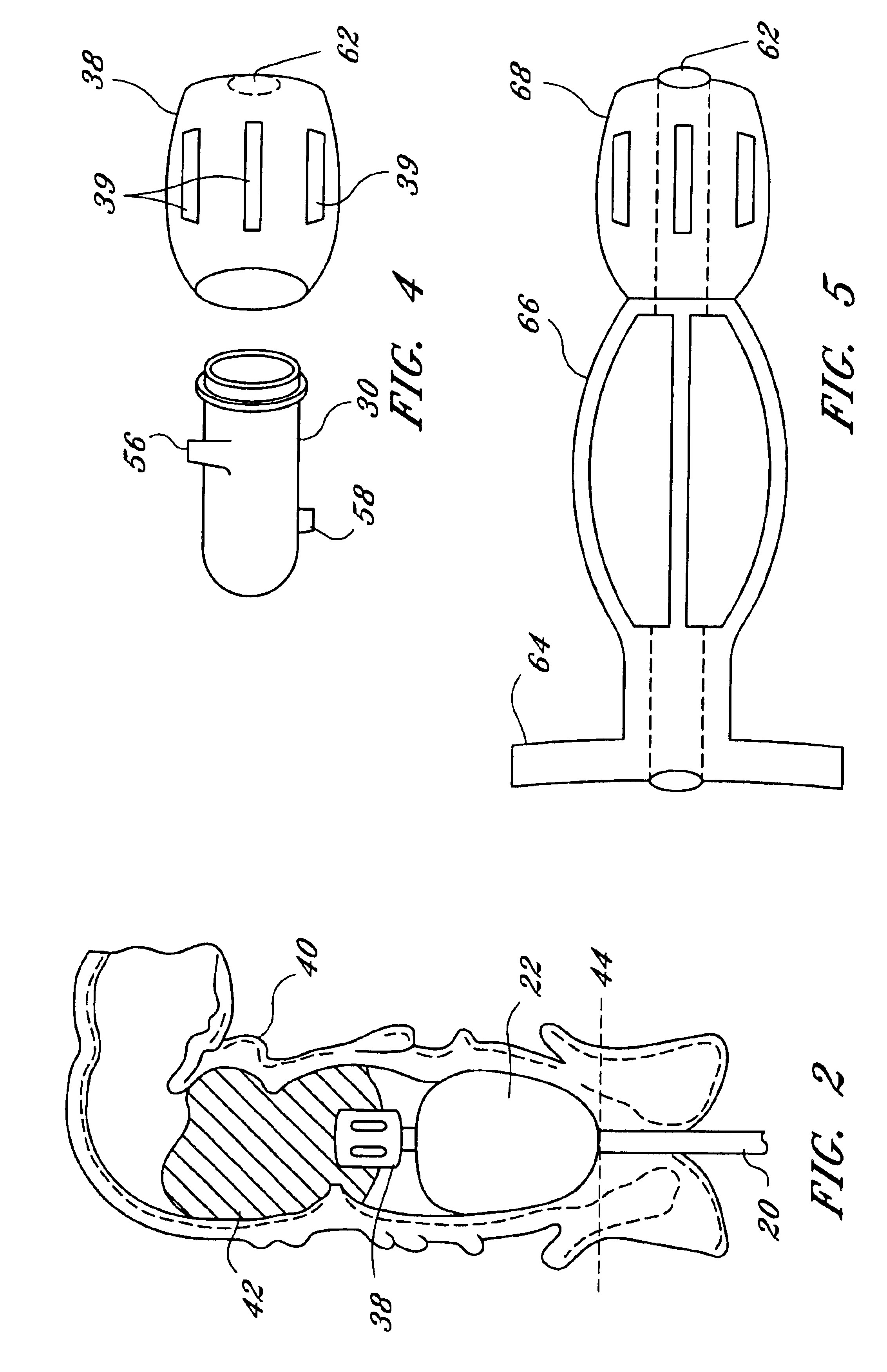 Fecal incontinence management device