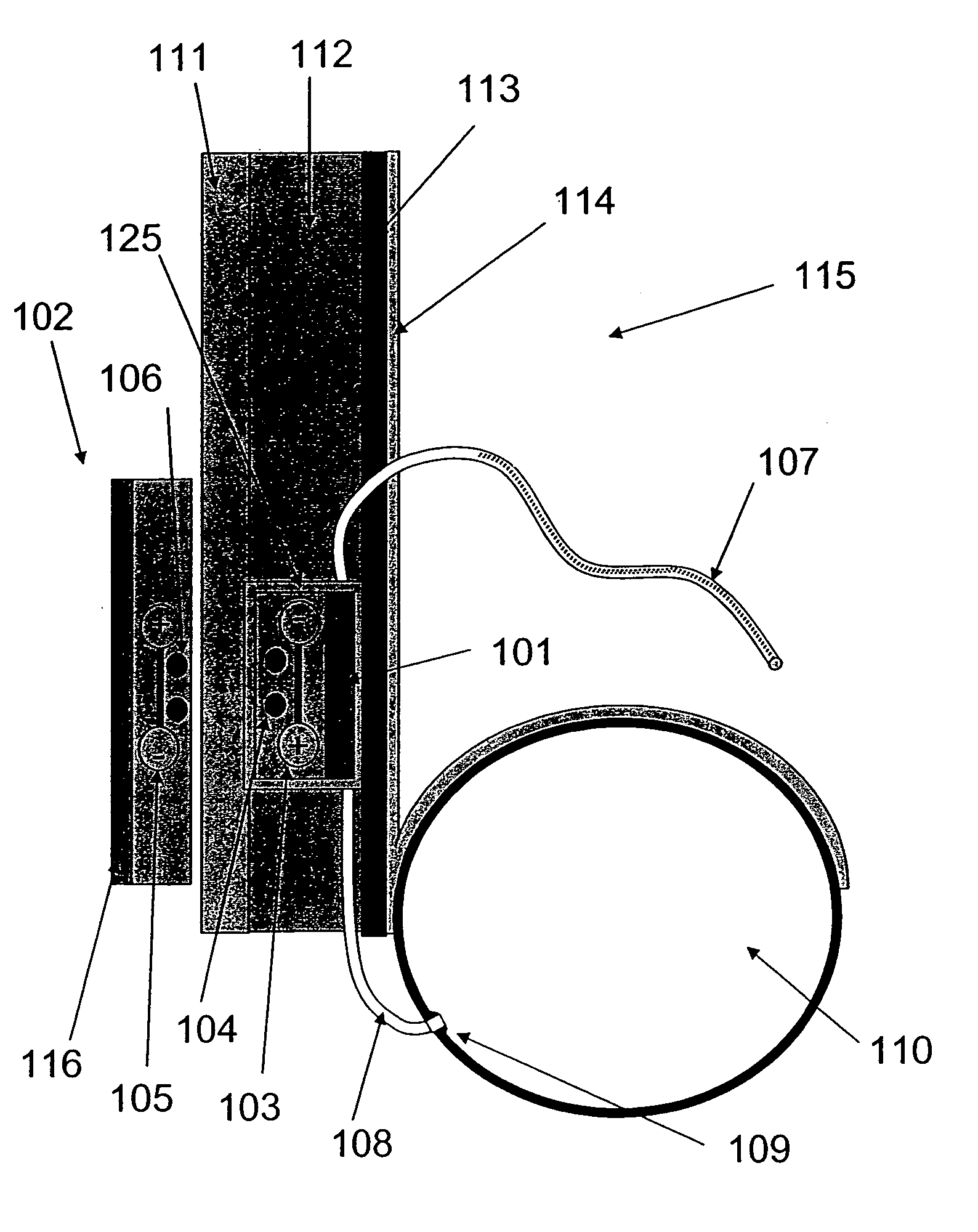 Implantable fluid management system for the removal of excess fluid