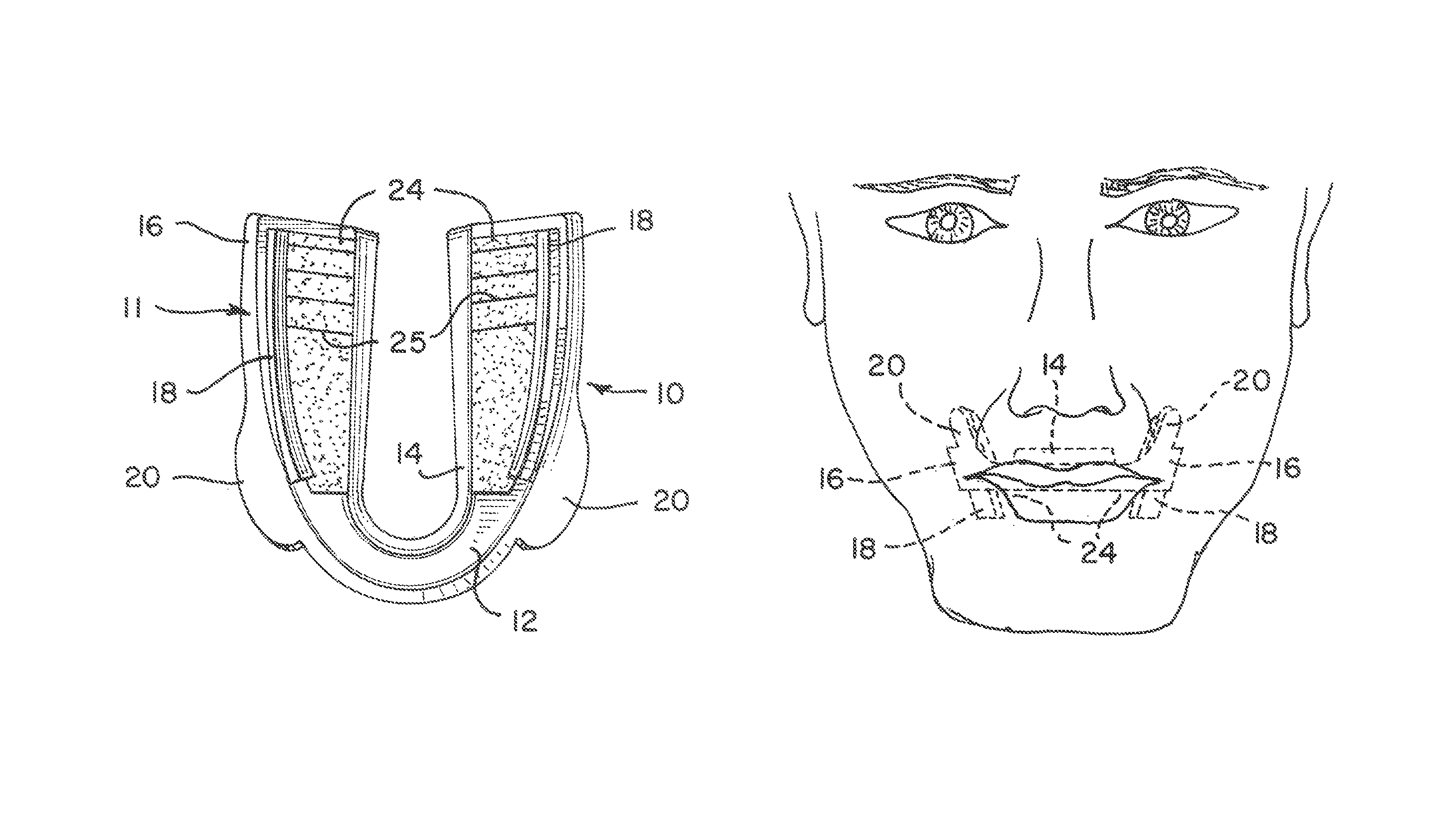 Dental appliance and method of fitting