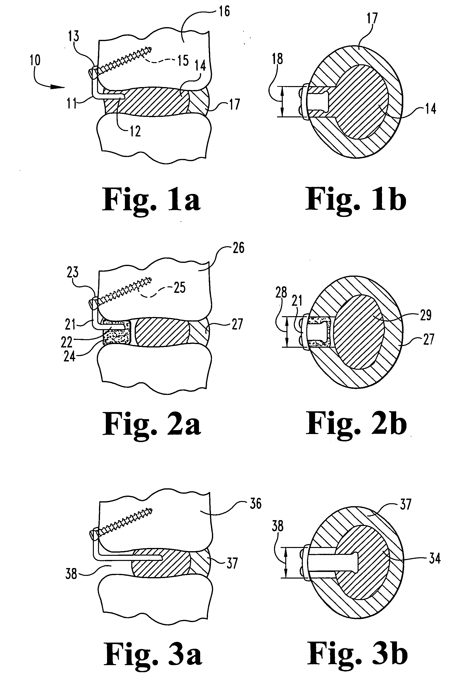System and method for blocking and/or retaining a prosthetic spinal implant