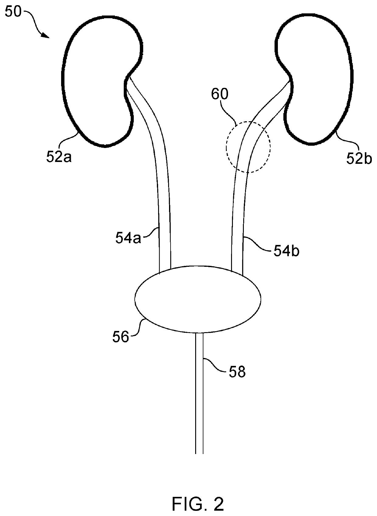 Apparatus for treating urinary tract infections
