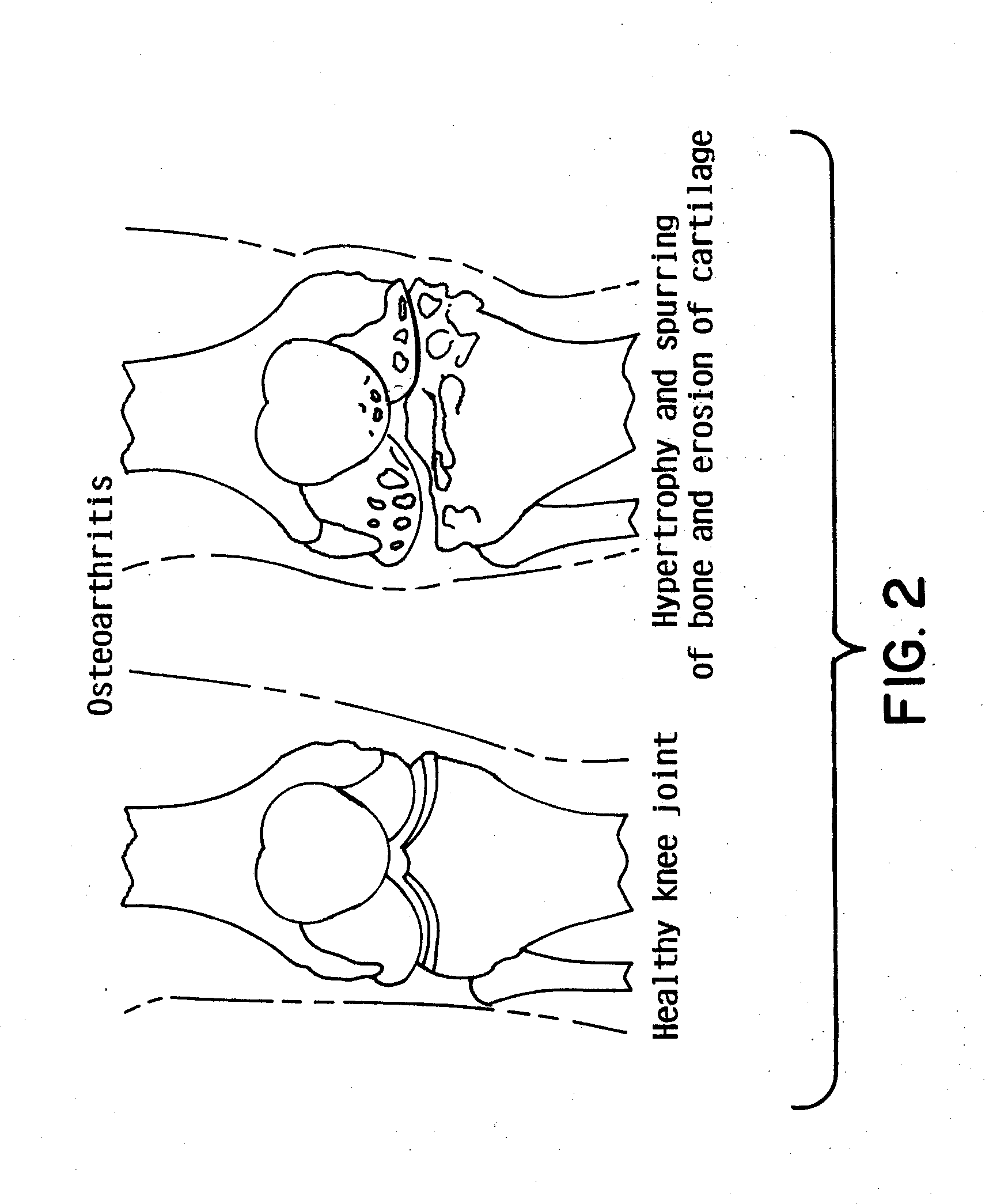 Low friction resurfacing implant