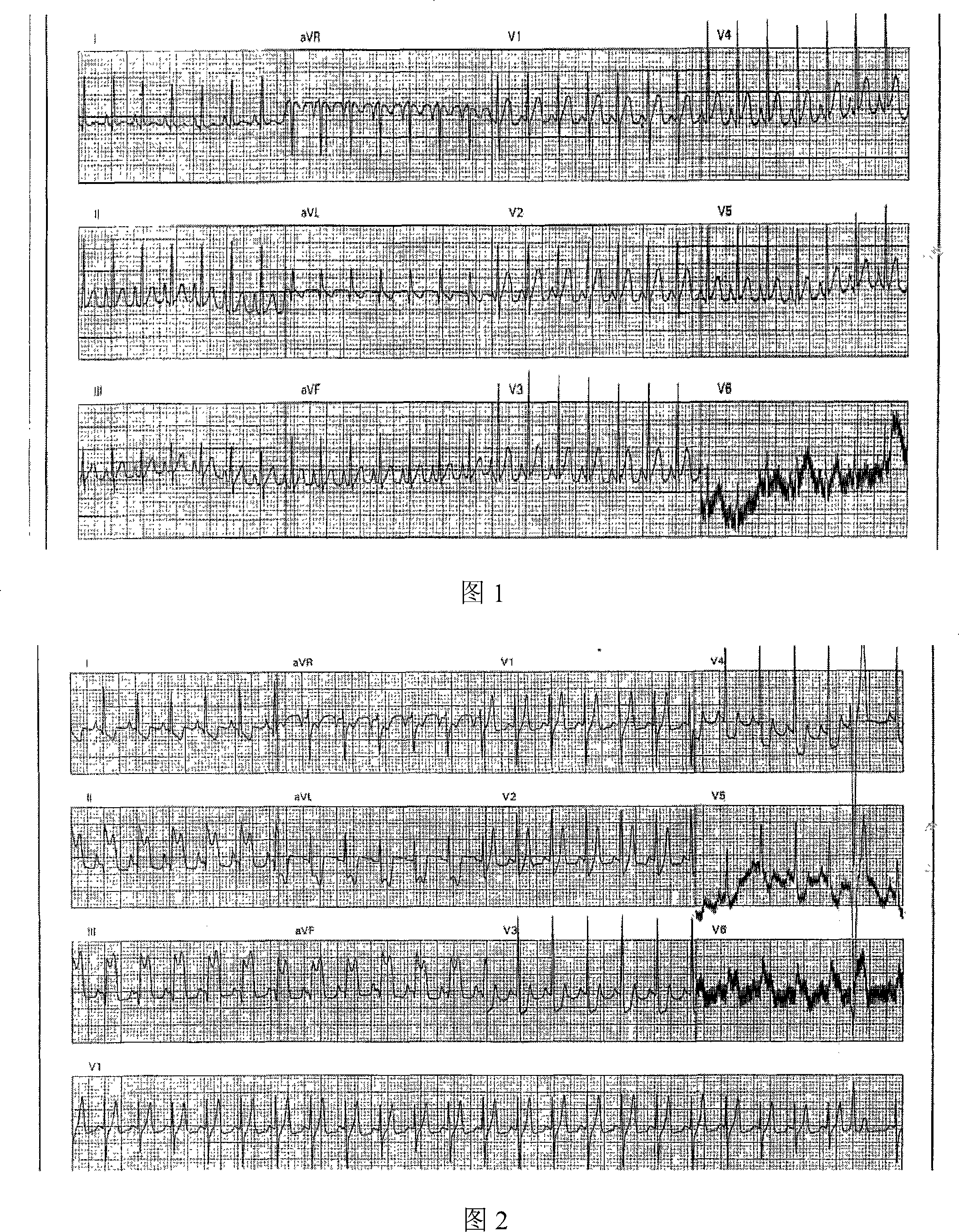 Establishing beagle dog myocardial infarction model using polythene foam plugging method