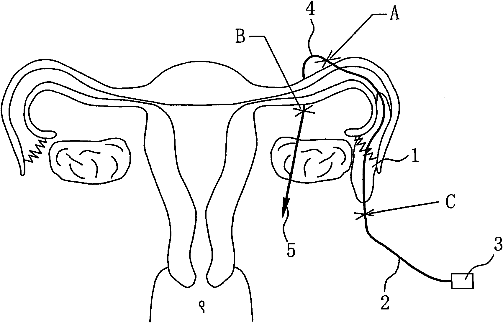 Reducible uterine tube umbrella mouth implanted type combined birth control device