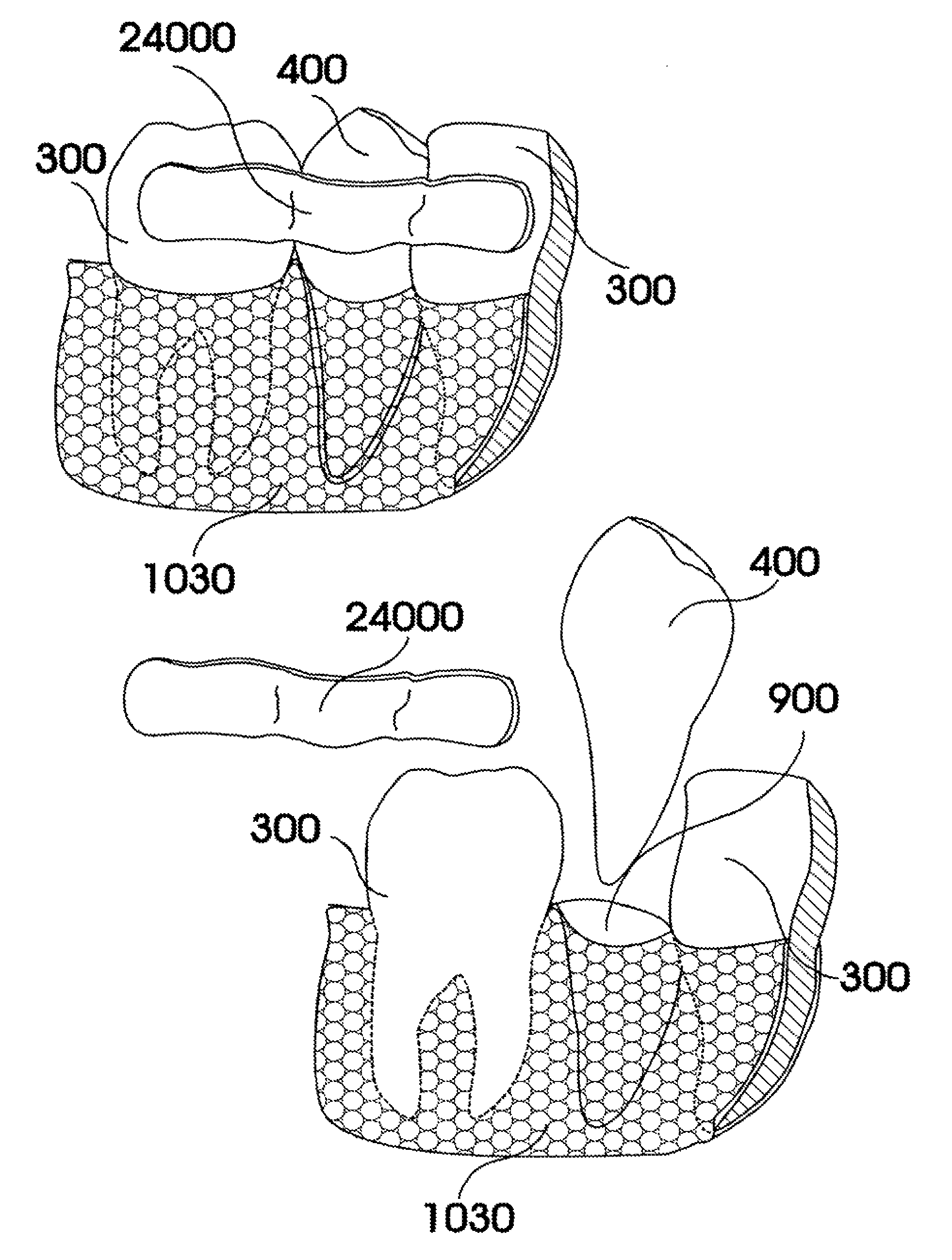 Customized dental prosthesis for periodontal or osseointegration and related systems and methods