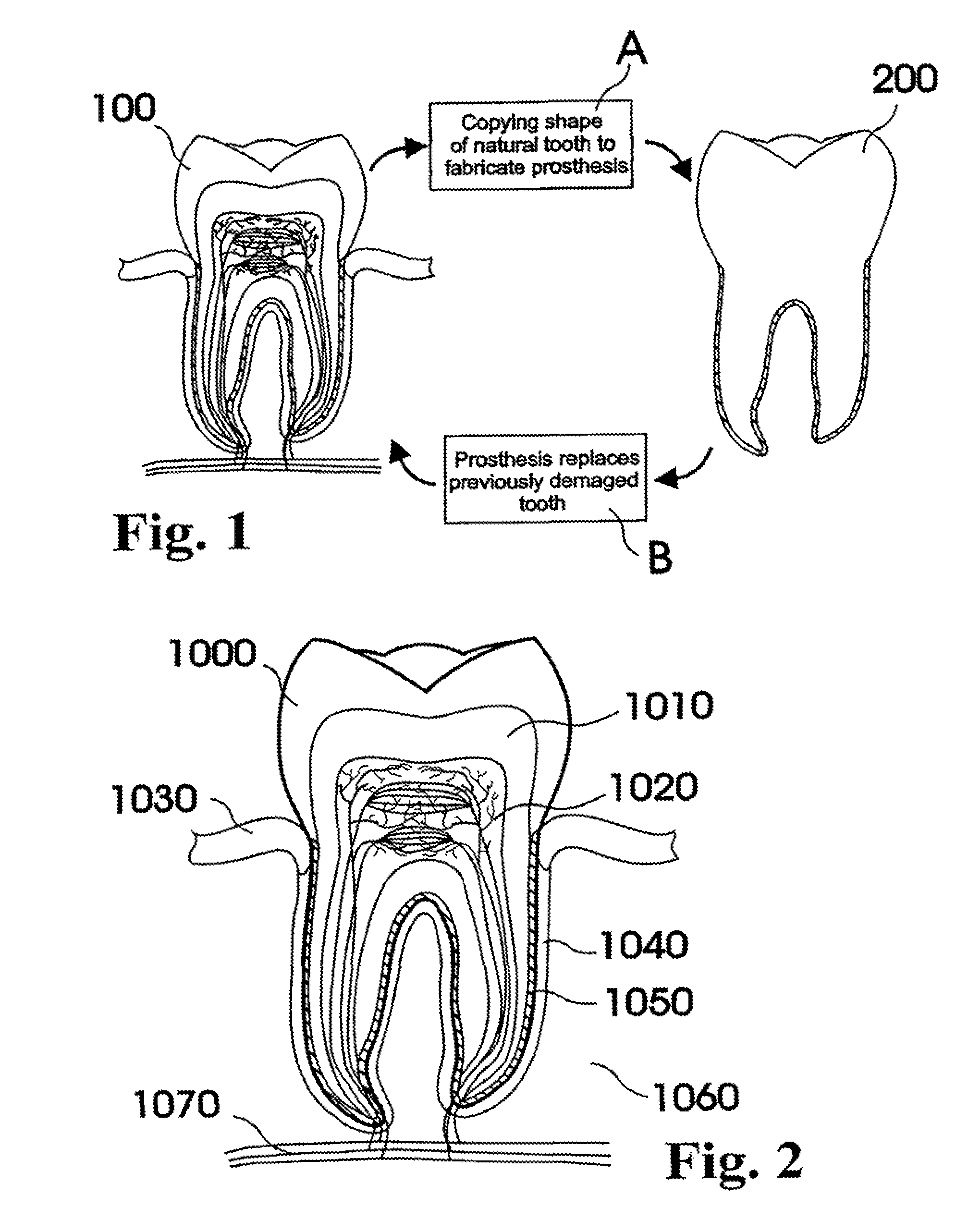 Customized dental prosthesis for periodontal or osseointegration and related systems and methods