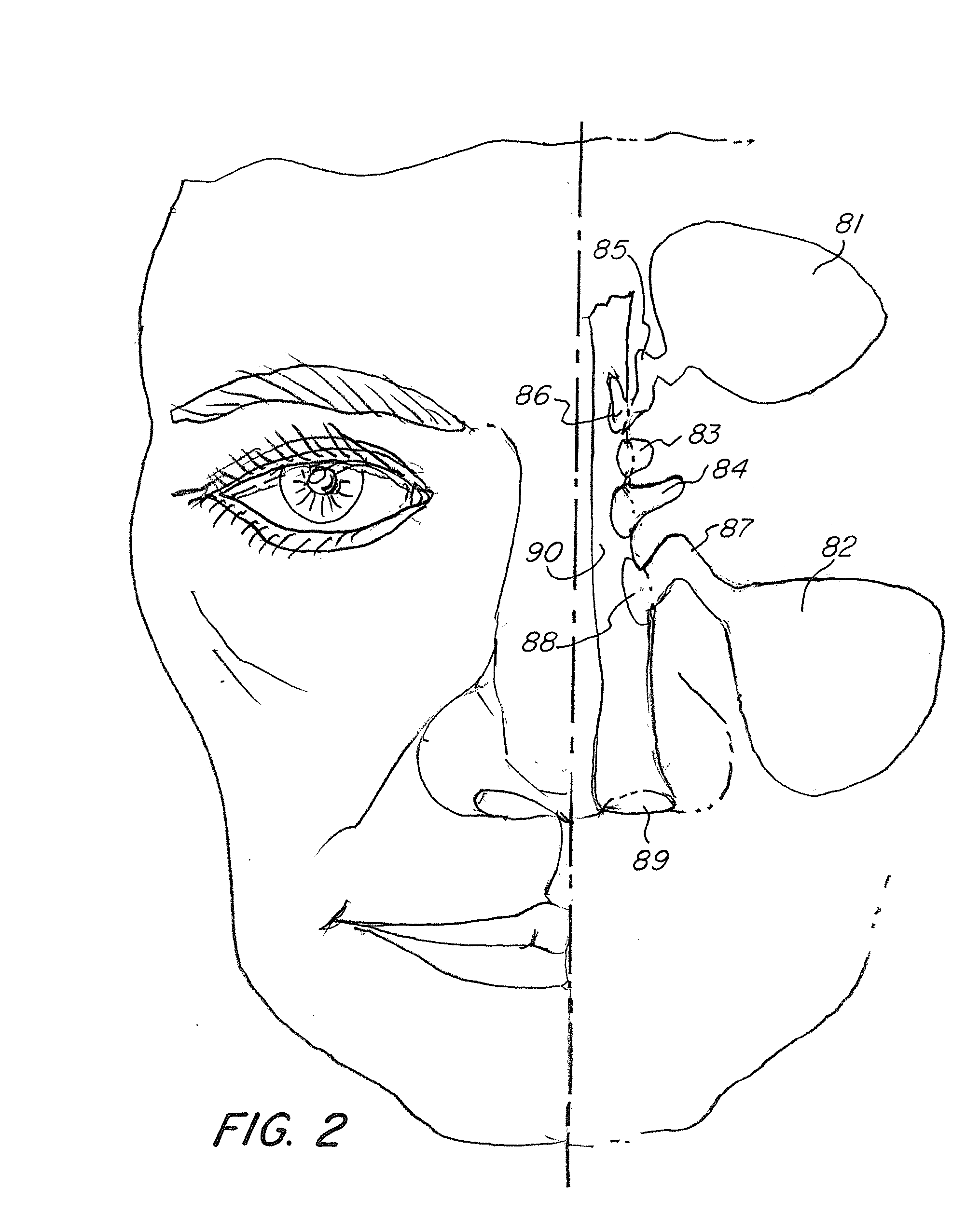 Nasal Delivery of Agents with Nested Balloon Catheter