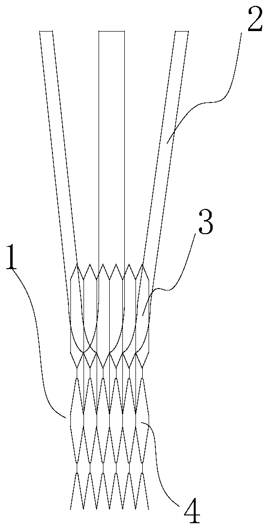 Transcatheter implanted aortic valve stent