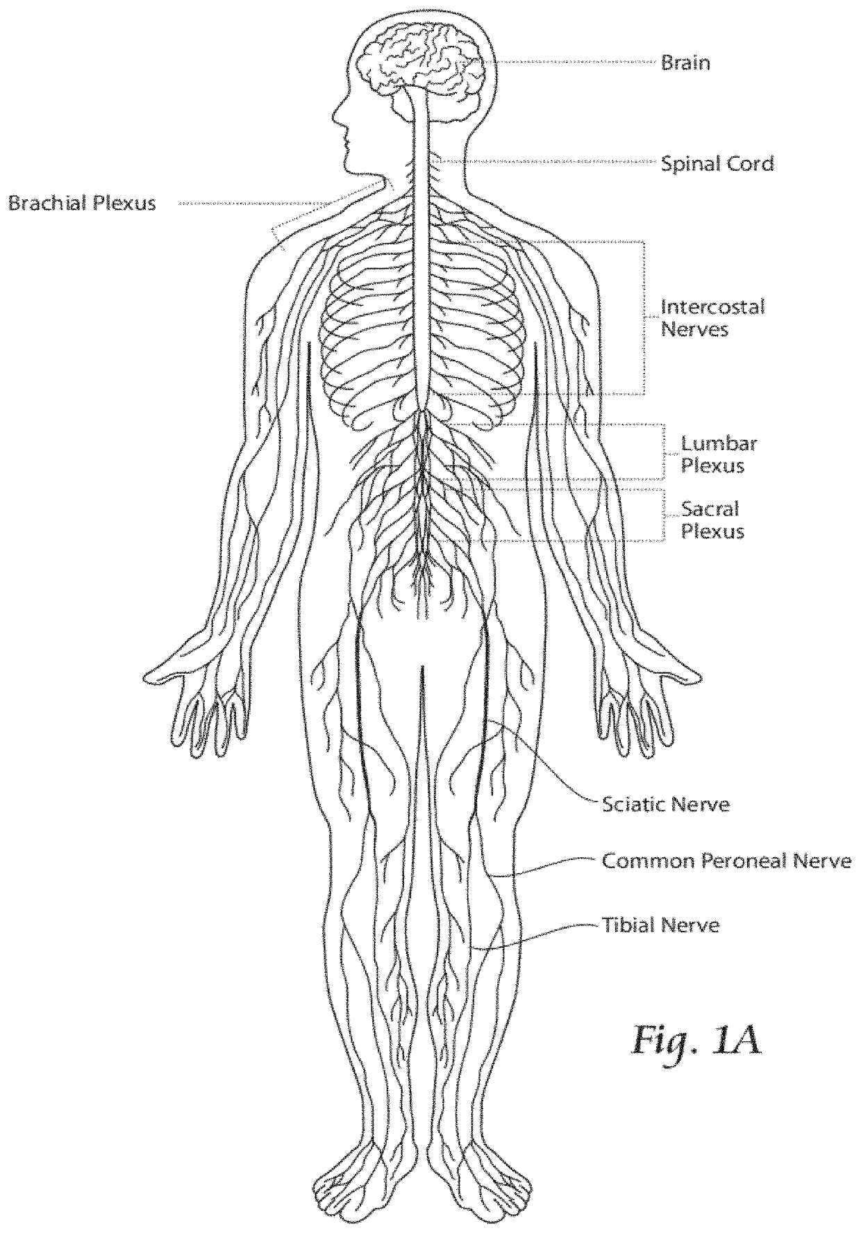 Systems and methods to place one or more leads in tissue to electrically stimulate nerves to treat pain