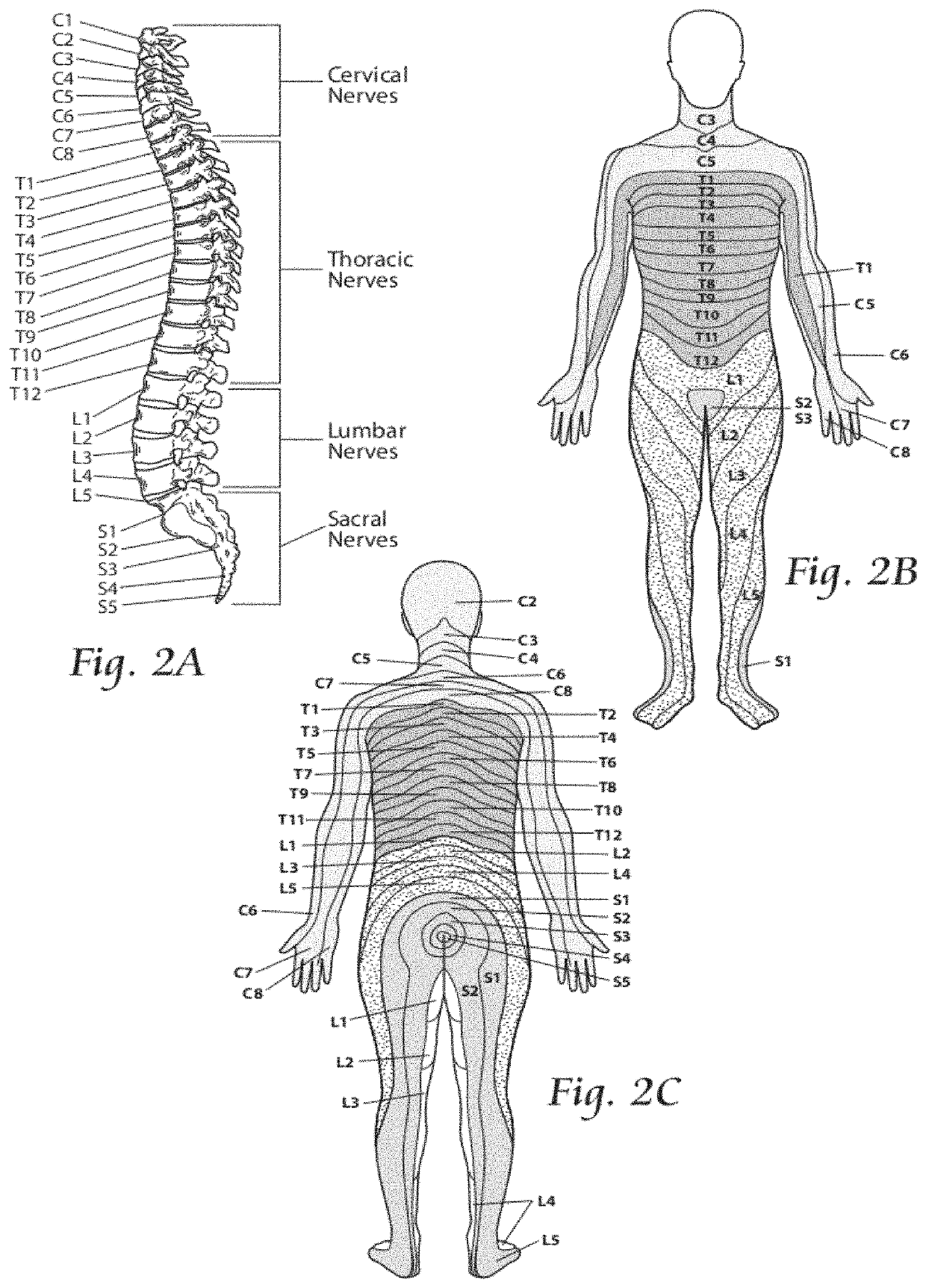 Systems and methods to place one or more leads in tissue to electrically stimulate nerves to treat pain