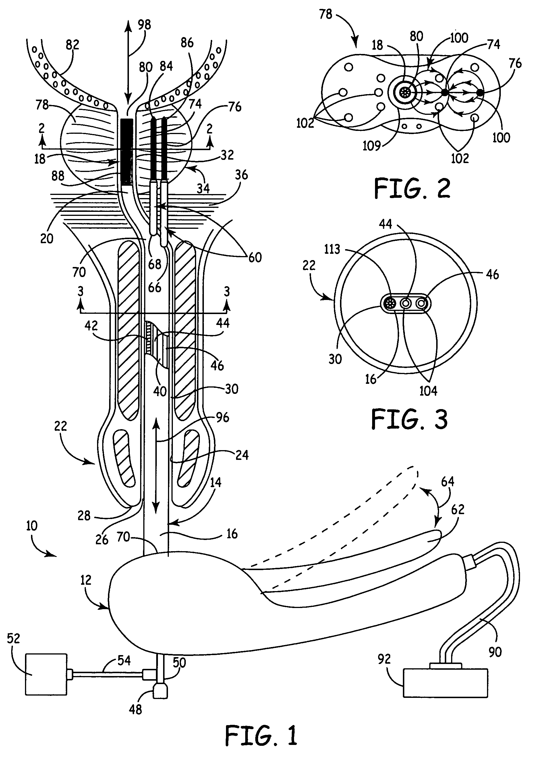 Apparatus and method for the treatment of benign prostatic hyperplasia