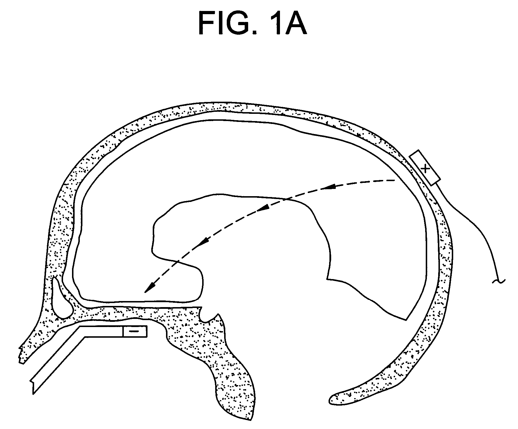 Method of removing deleterious charged molecules from brain tissue