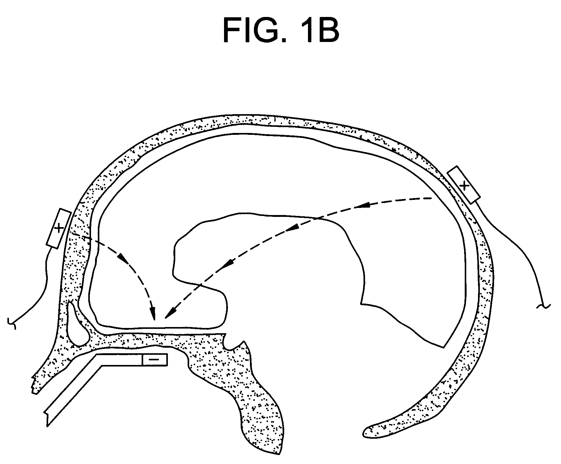 Method of removing deleterious charged molecules from brain tissue