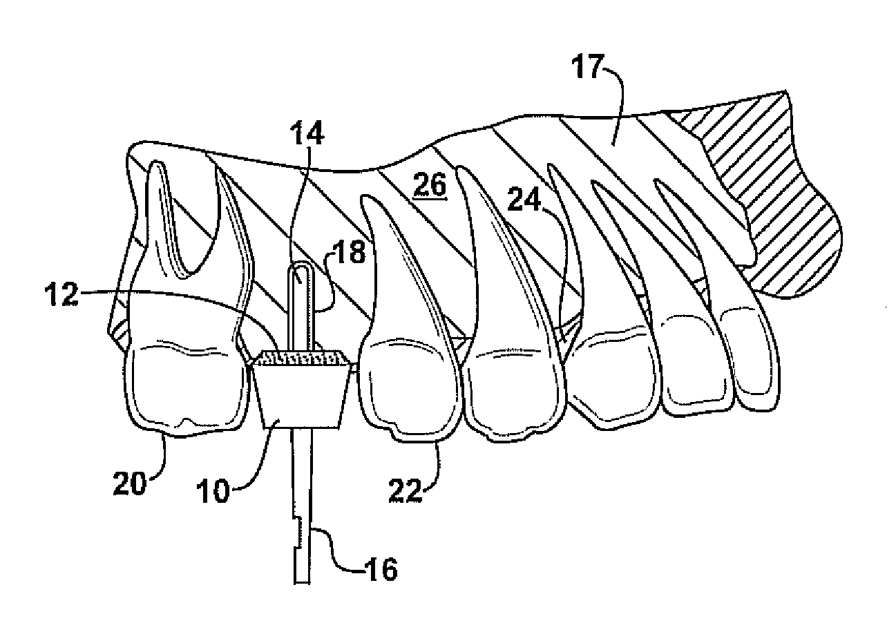 Method and apparatus for performing dental implantation