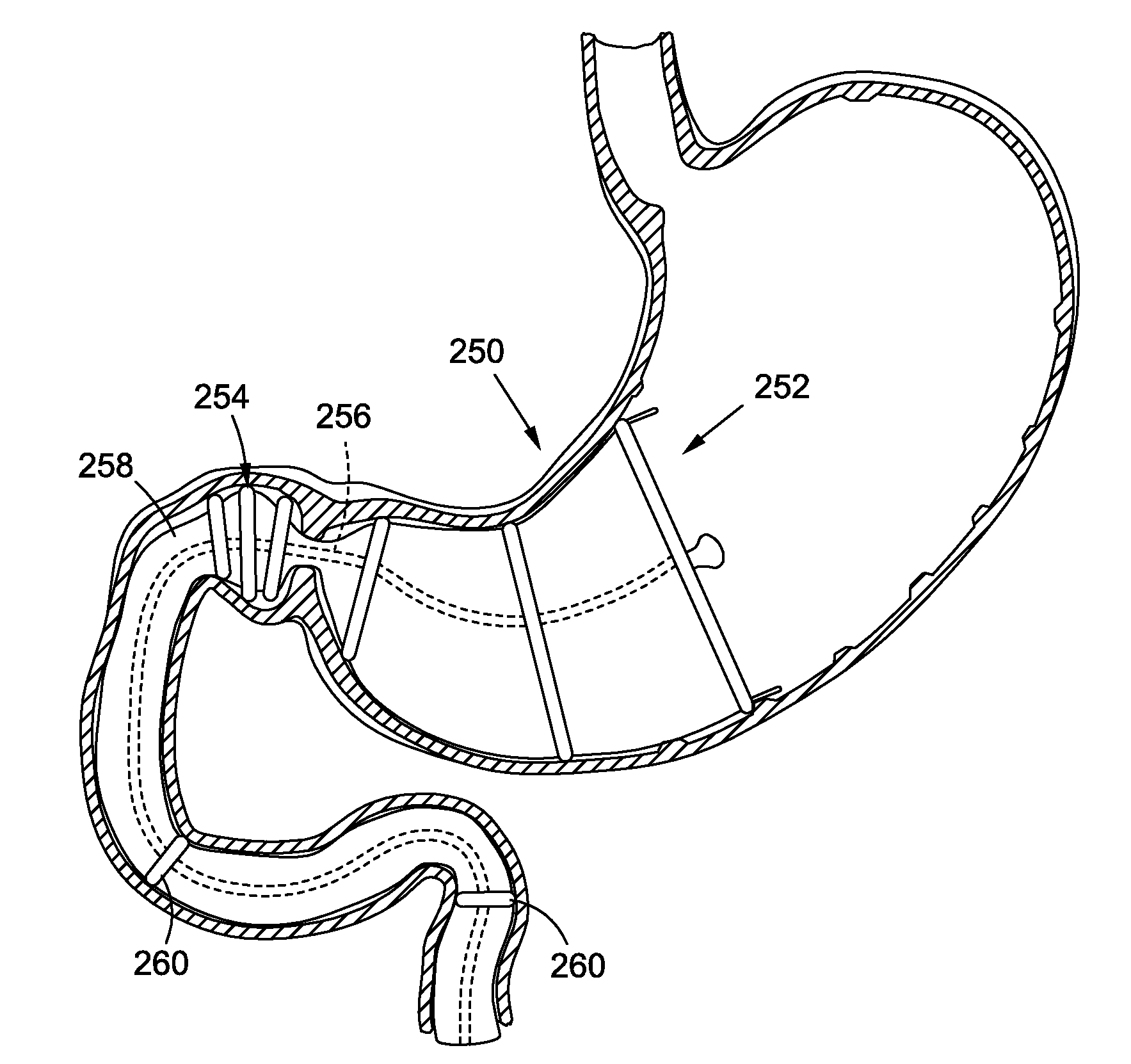 Anchored non-piercing duodenal sleeve and delivery systems