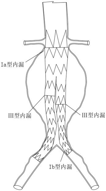 Downward moving device for stent anchoring area