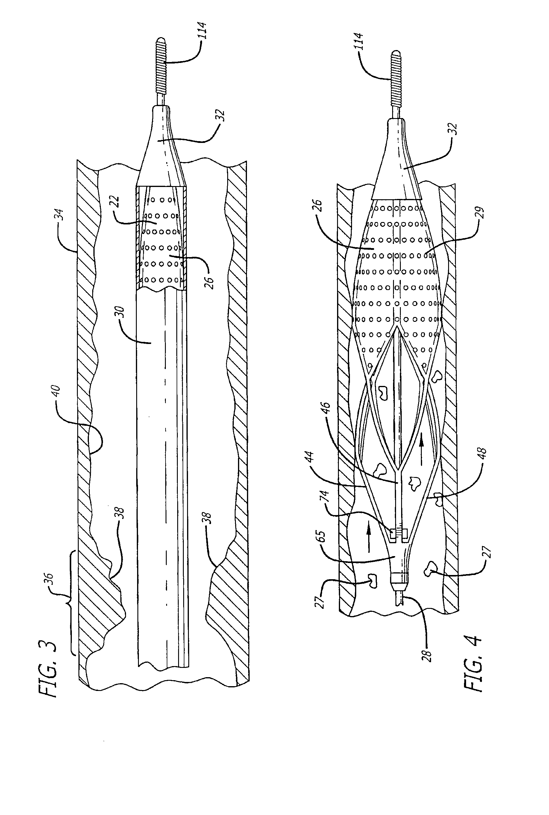 Cage and sleeve assembly for a filtering device