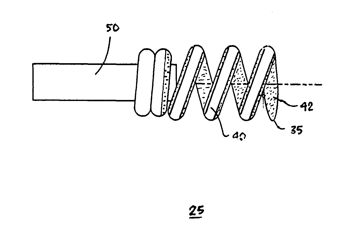 High impedance active fixation electrode of an electrical medical lead