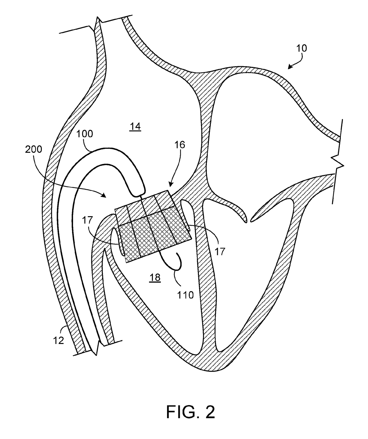 Percutaneously-deployable prosthetic tricuspid valve