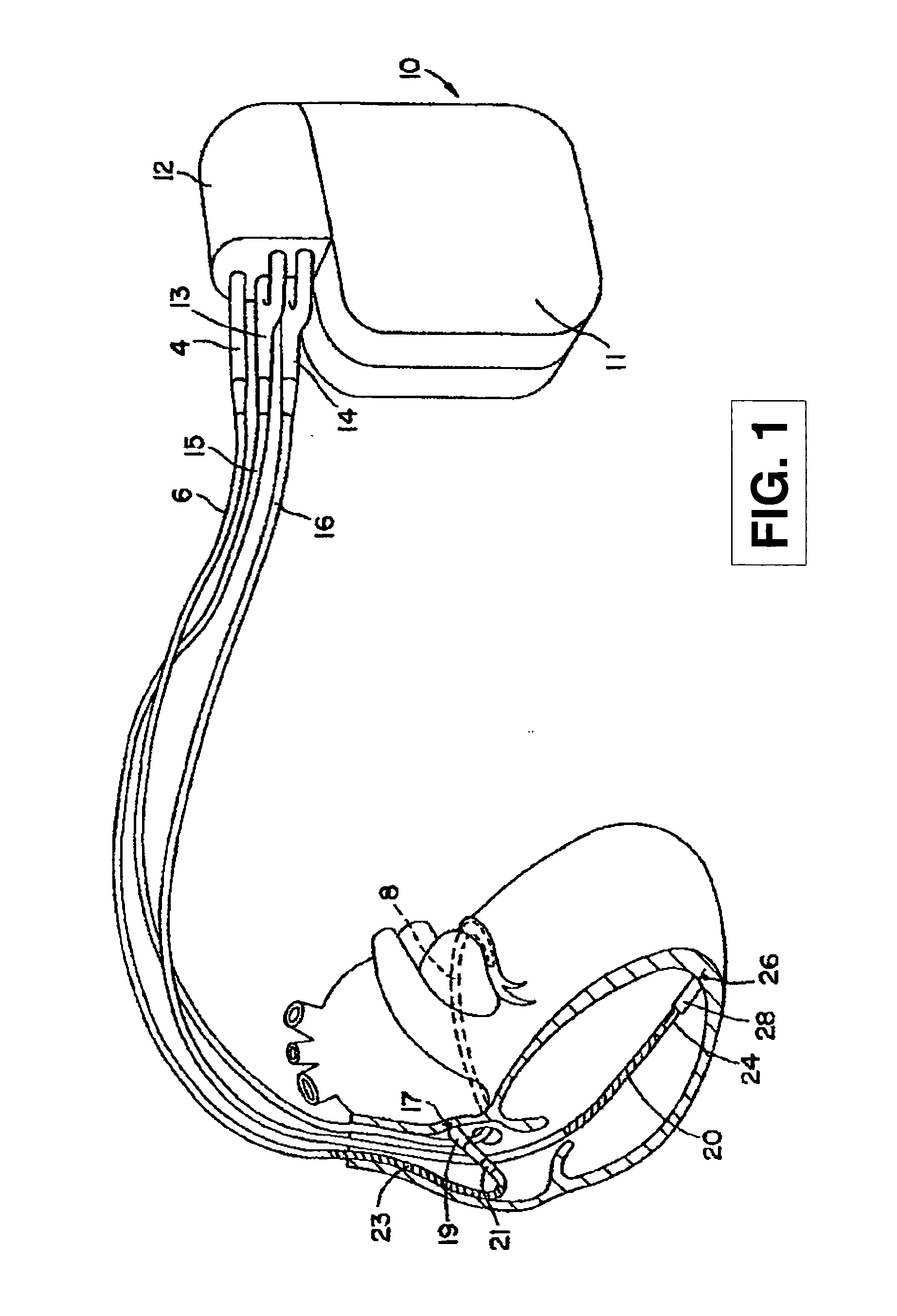 Method and apparatus for generating a template for arrhythmia detection and electrogram morphology classification
