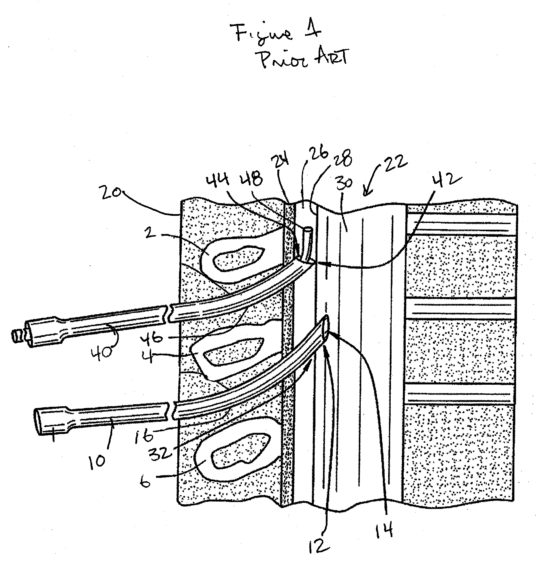 Spinal needle light guide apparatus and method of delivery