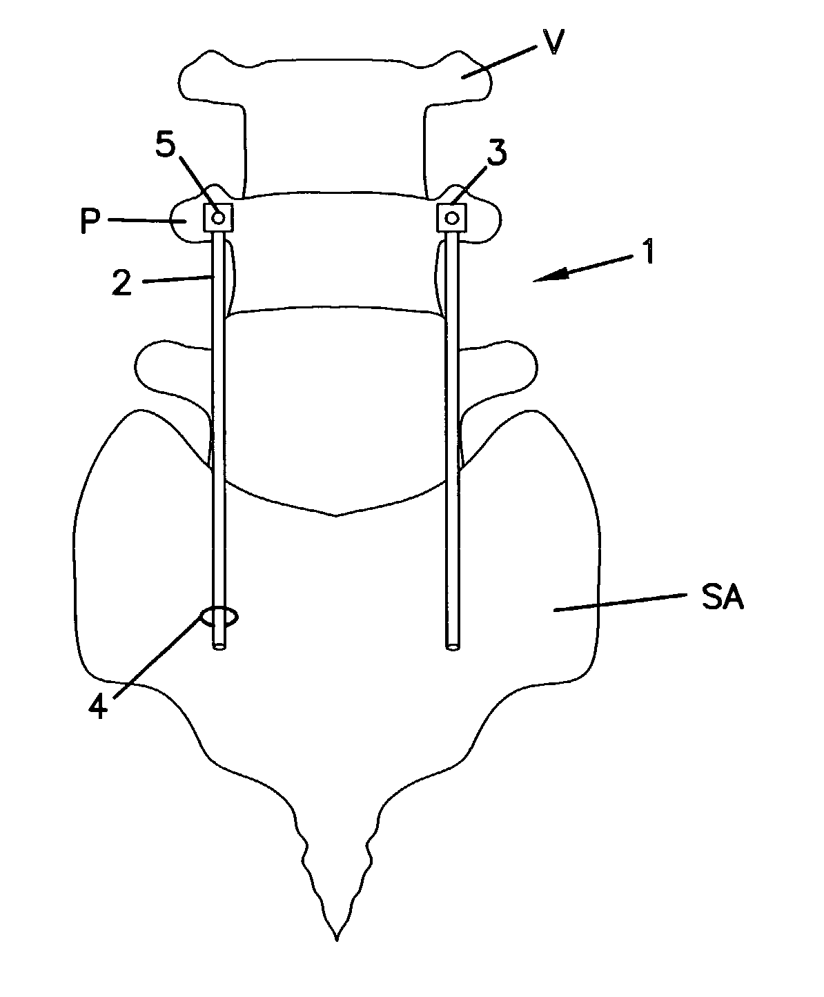 Spinal fixation device and method