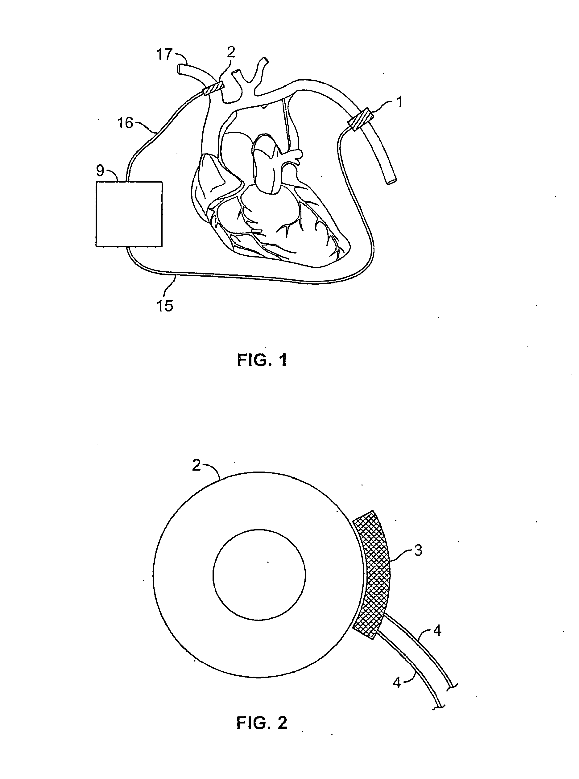 Methods and devices for counteracting hypotension