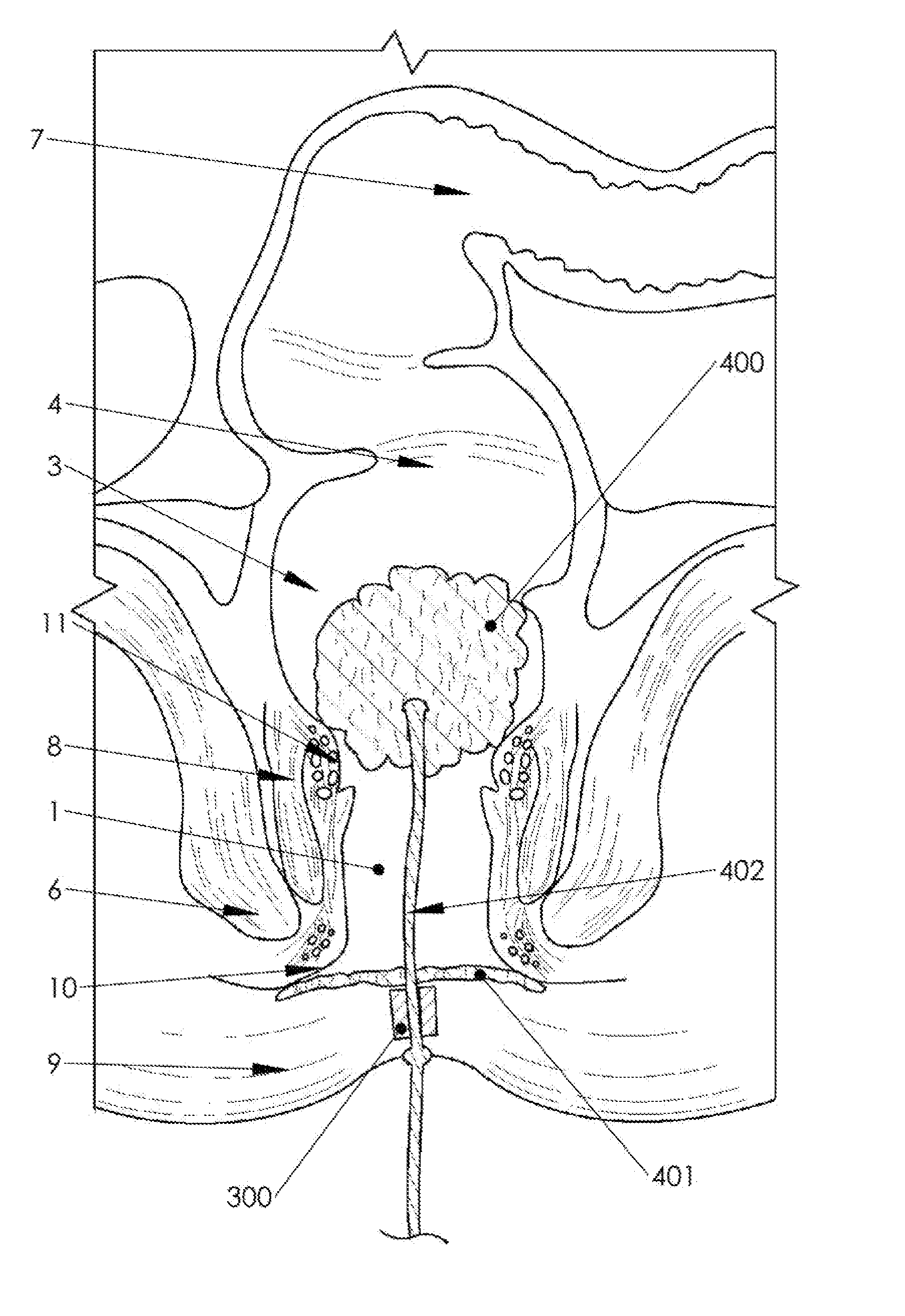 Device and method to avert anal fecal leakage