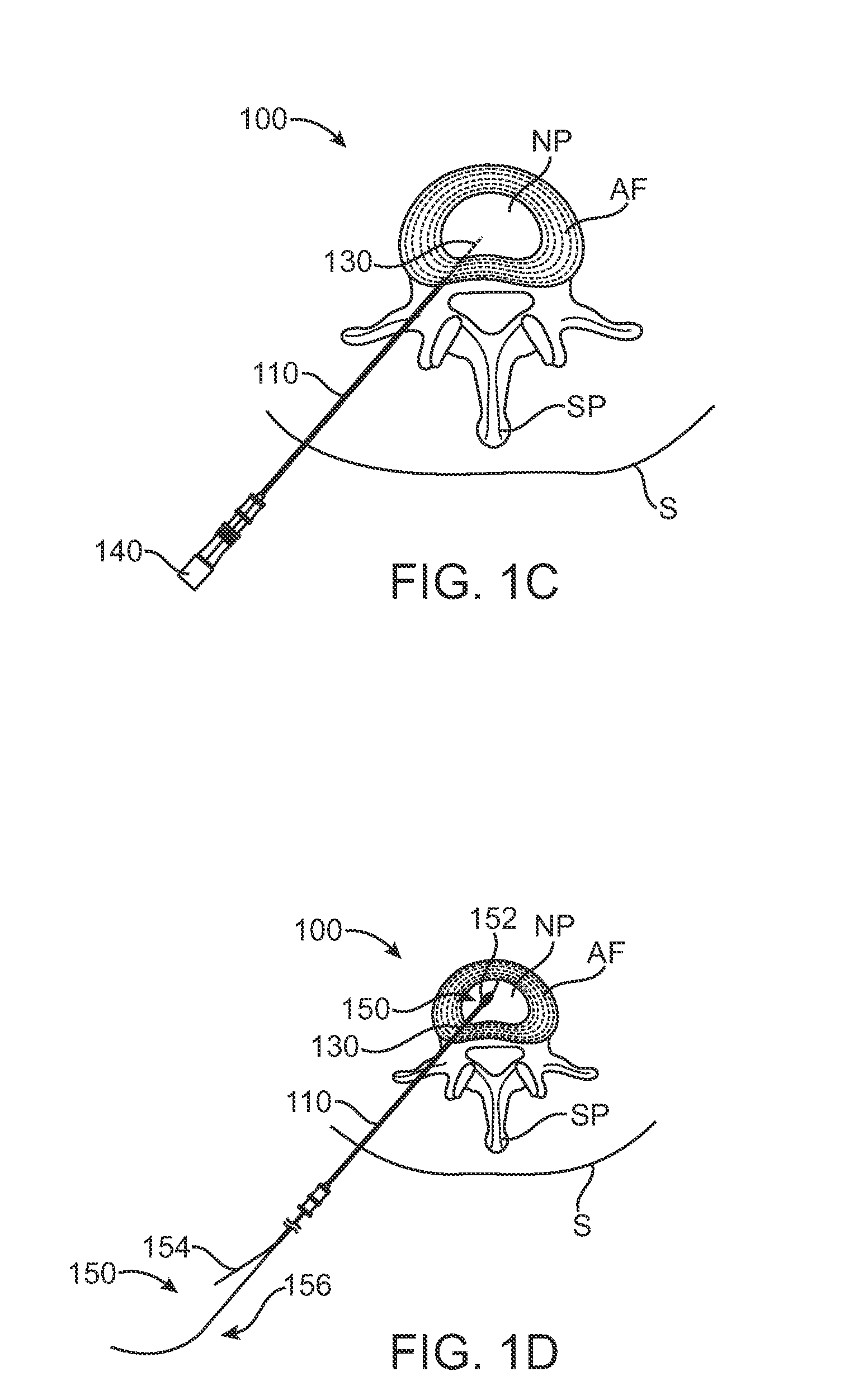 Systems and Methods for Needle Access to an Intervertebral Disc